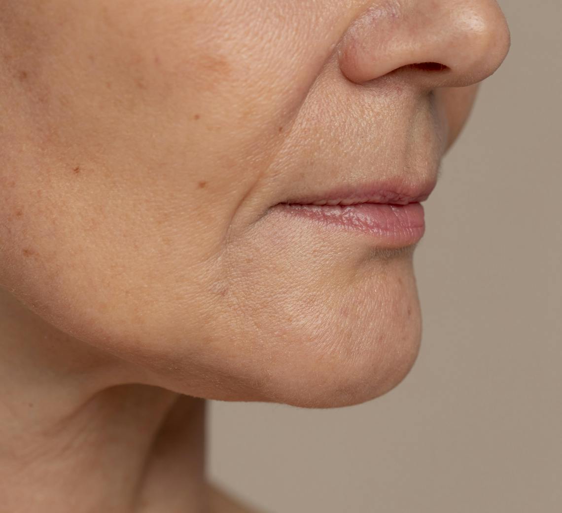 injection d'acide hyaluronique anti-âge