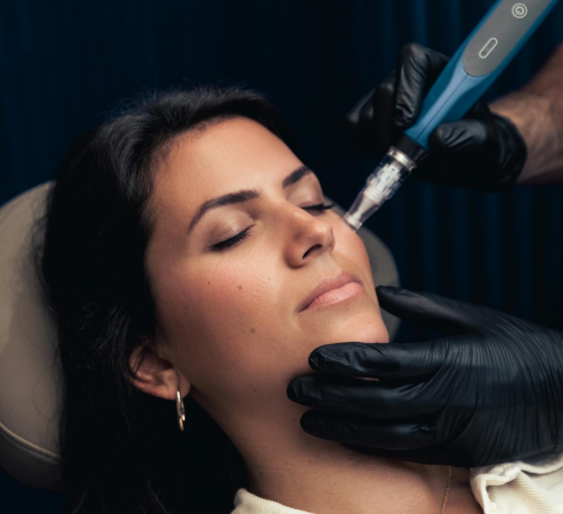 microneedling et acide hyaluronique contre les rides