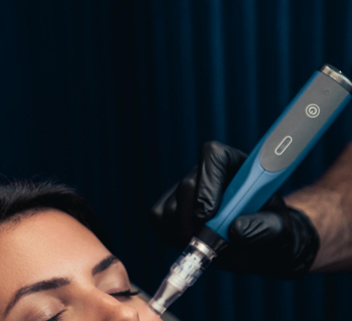 Alternatives au botox : microneedling, laser CO2 fractionné