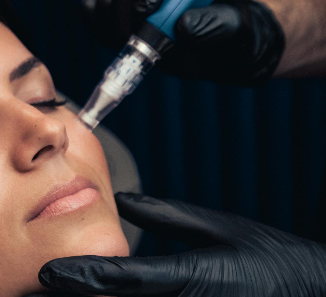 microneedling et acide hyaluronique contre les rides