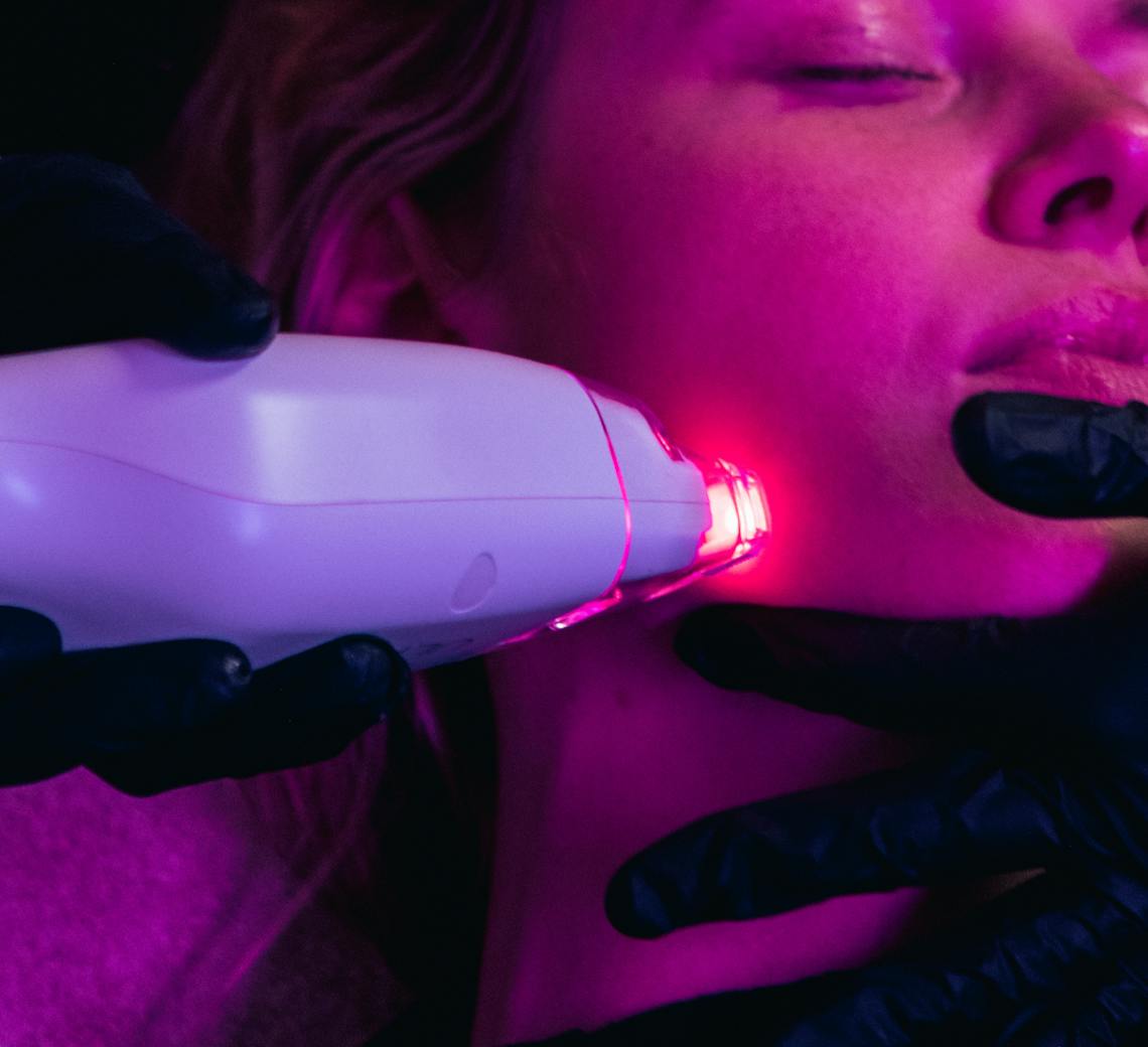 microneedling contre les rides