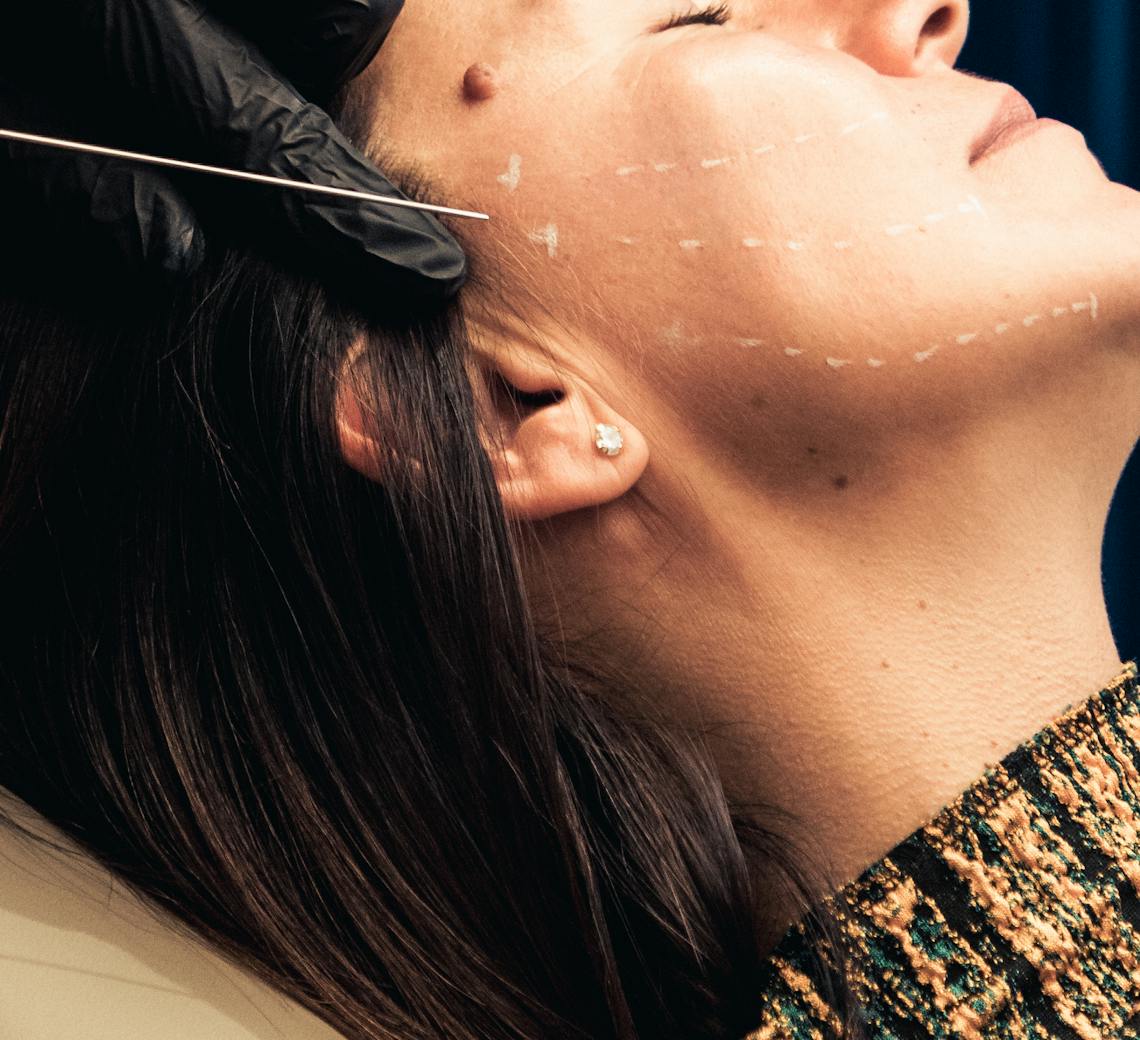 fils tenseurs pour l'ovale du visage