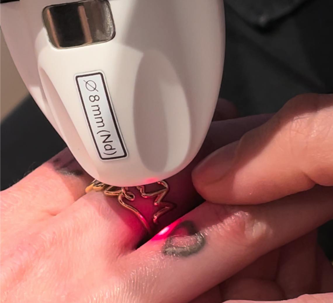 soin après détatouage laser | conseils Maison Yokō