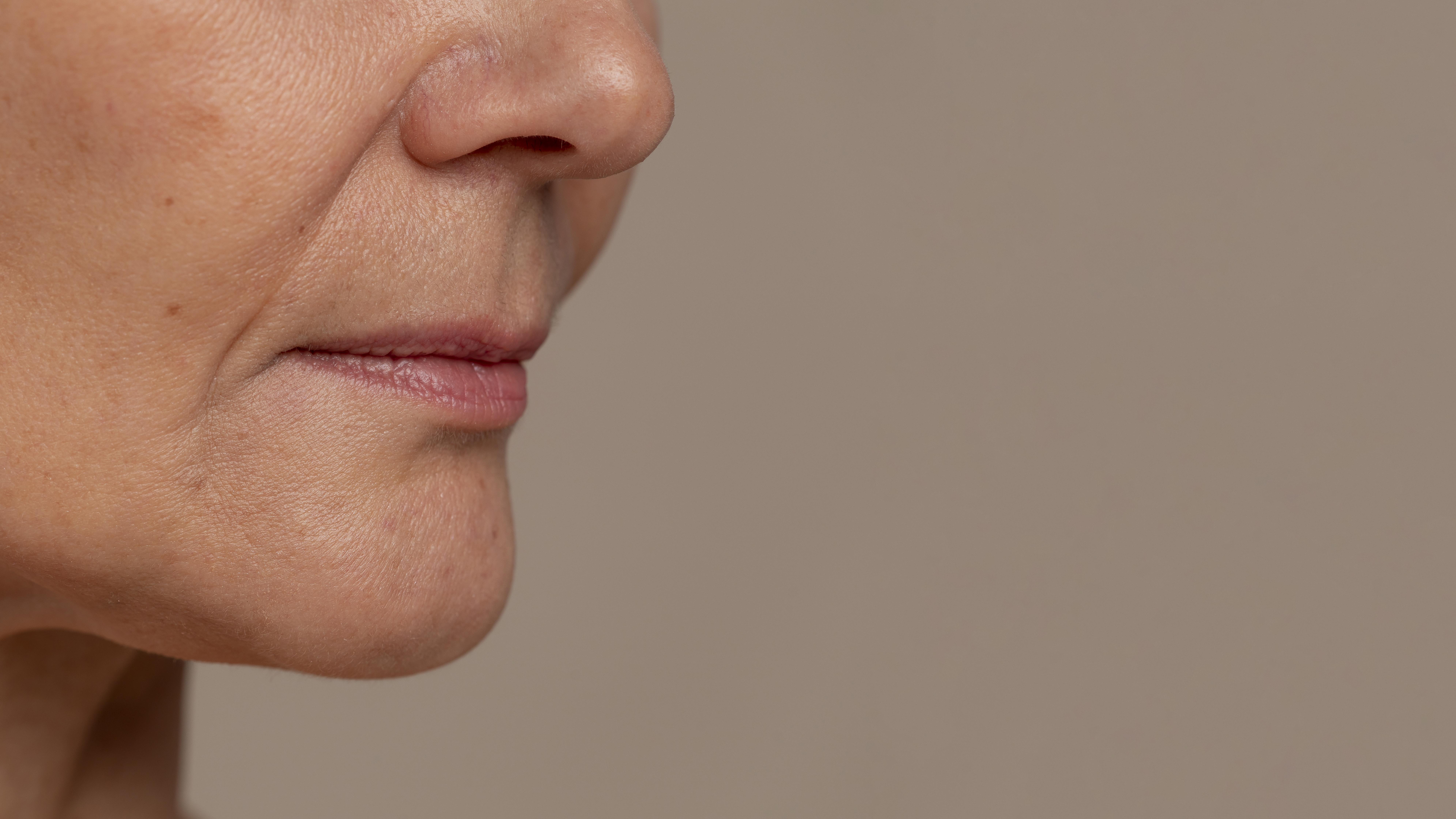 combler les rides sans injections