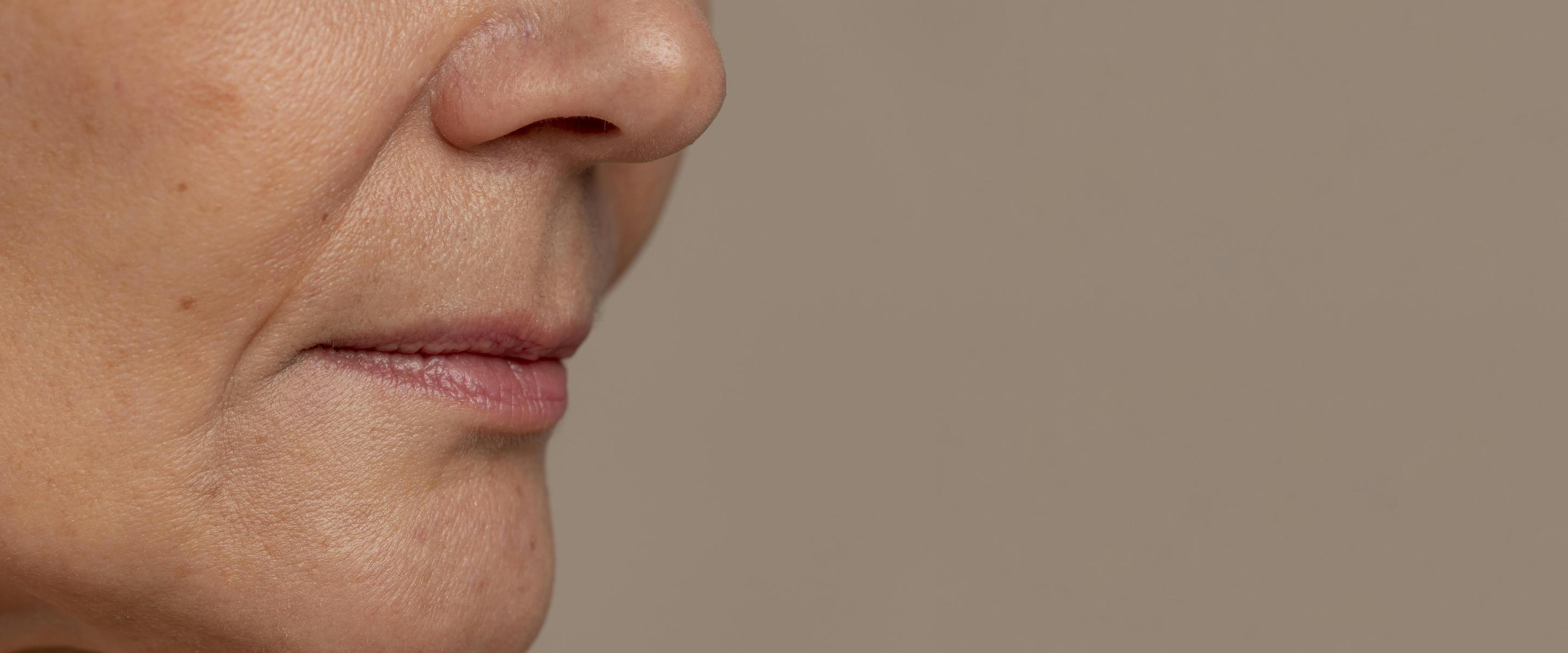 combler les rides sans injections