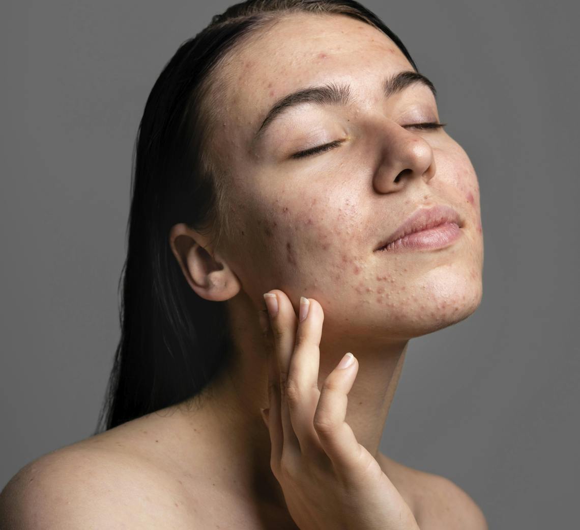 réduire les cicatrices d'acné sur le visage