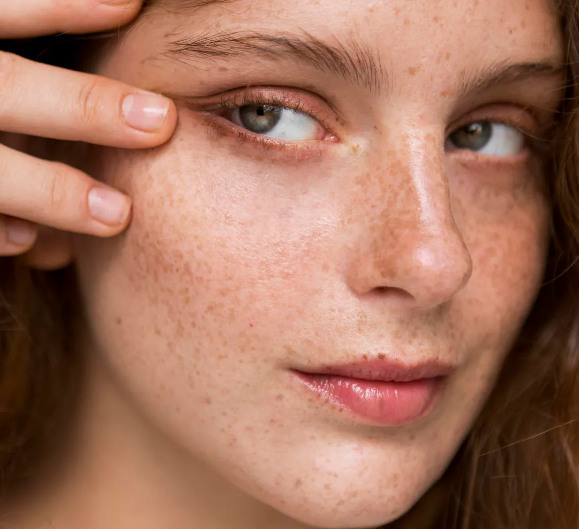 quels soins remplacent le laser en été ?