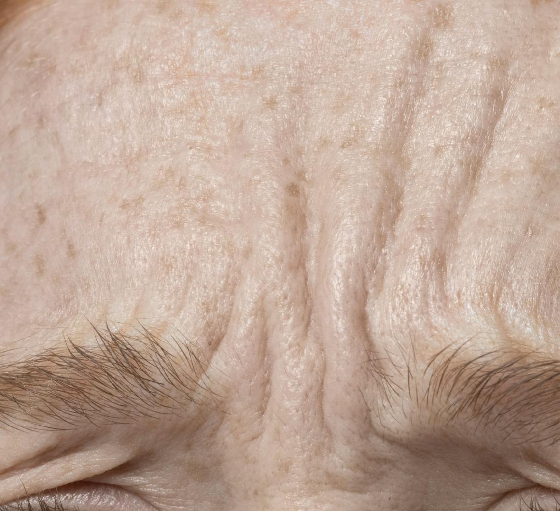 comment se forment les rides | solutions Maison Yokō