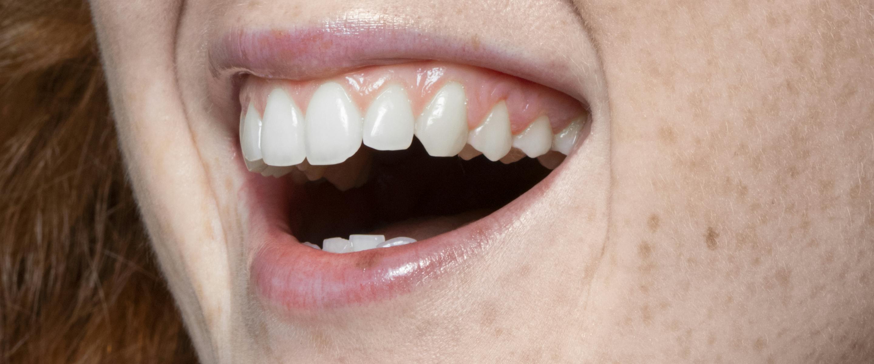 Injection de botox pour le sourire gingival | Maison Yokō