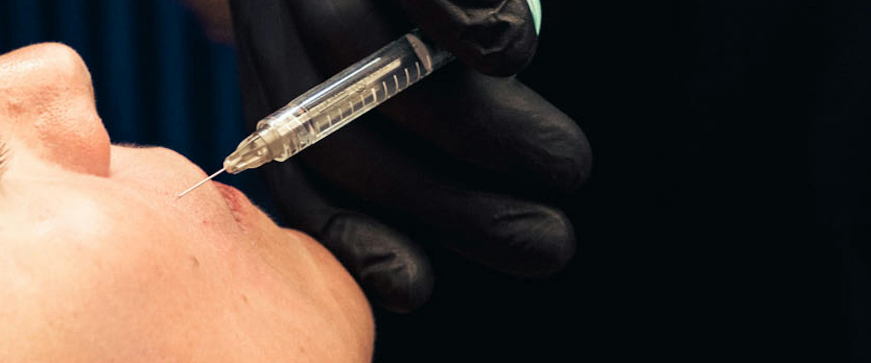 injection d'acide hyaluronique pommettes | Maison Yokō