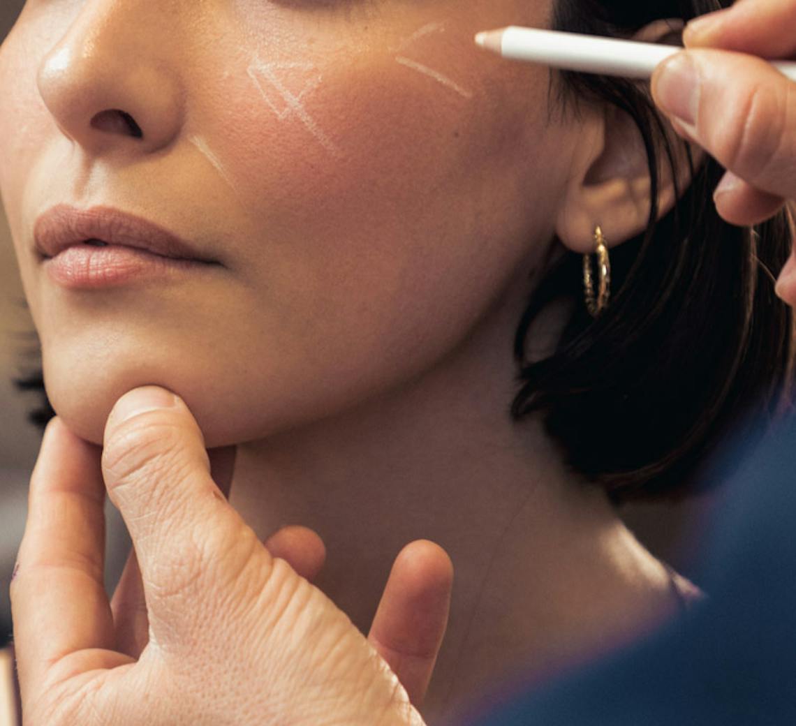 acide hyaluronique pommettes