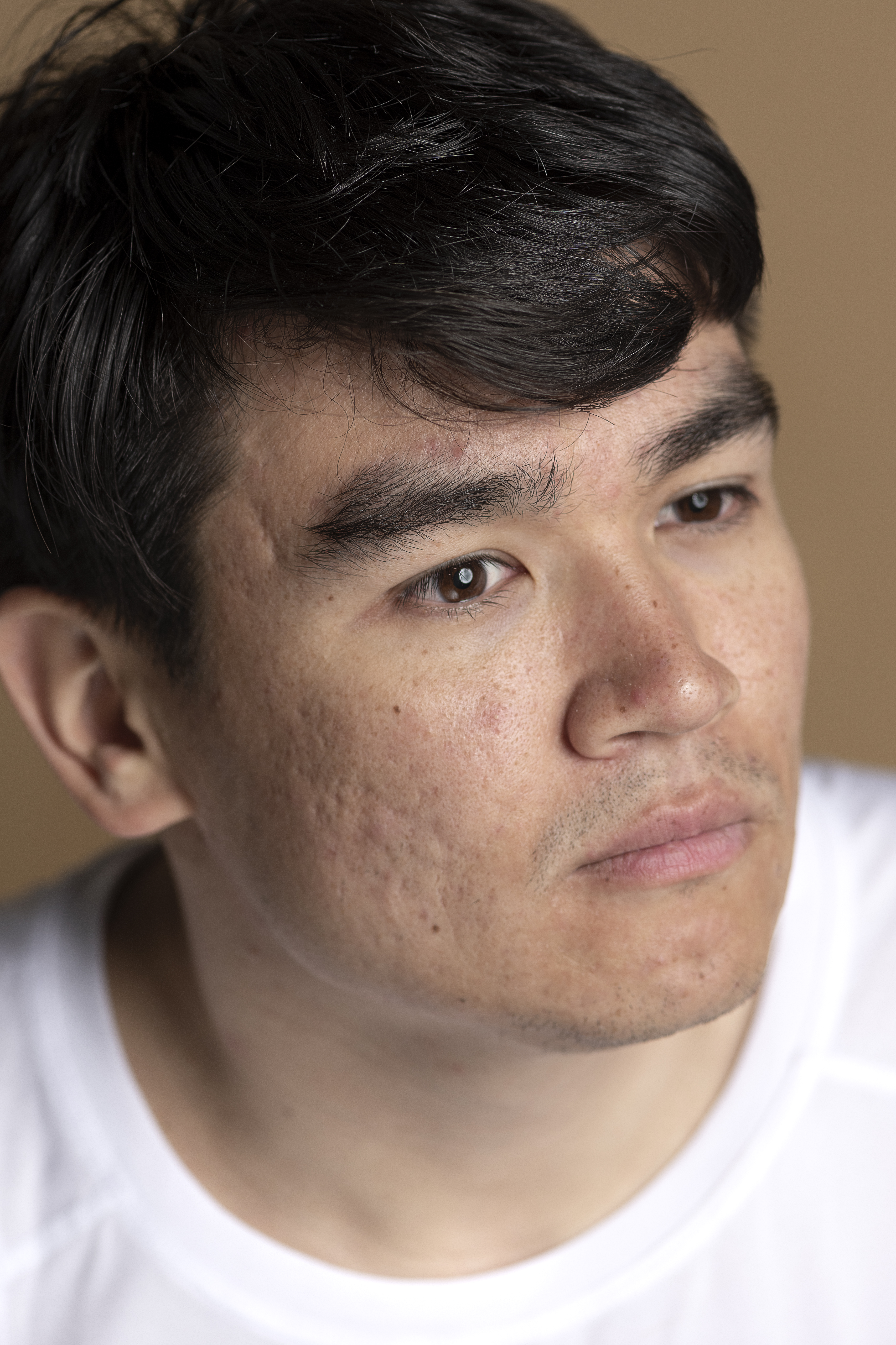 laser cicatrice d'acné Lyon | Maison Yokō