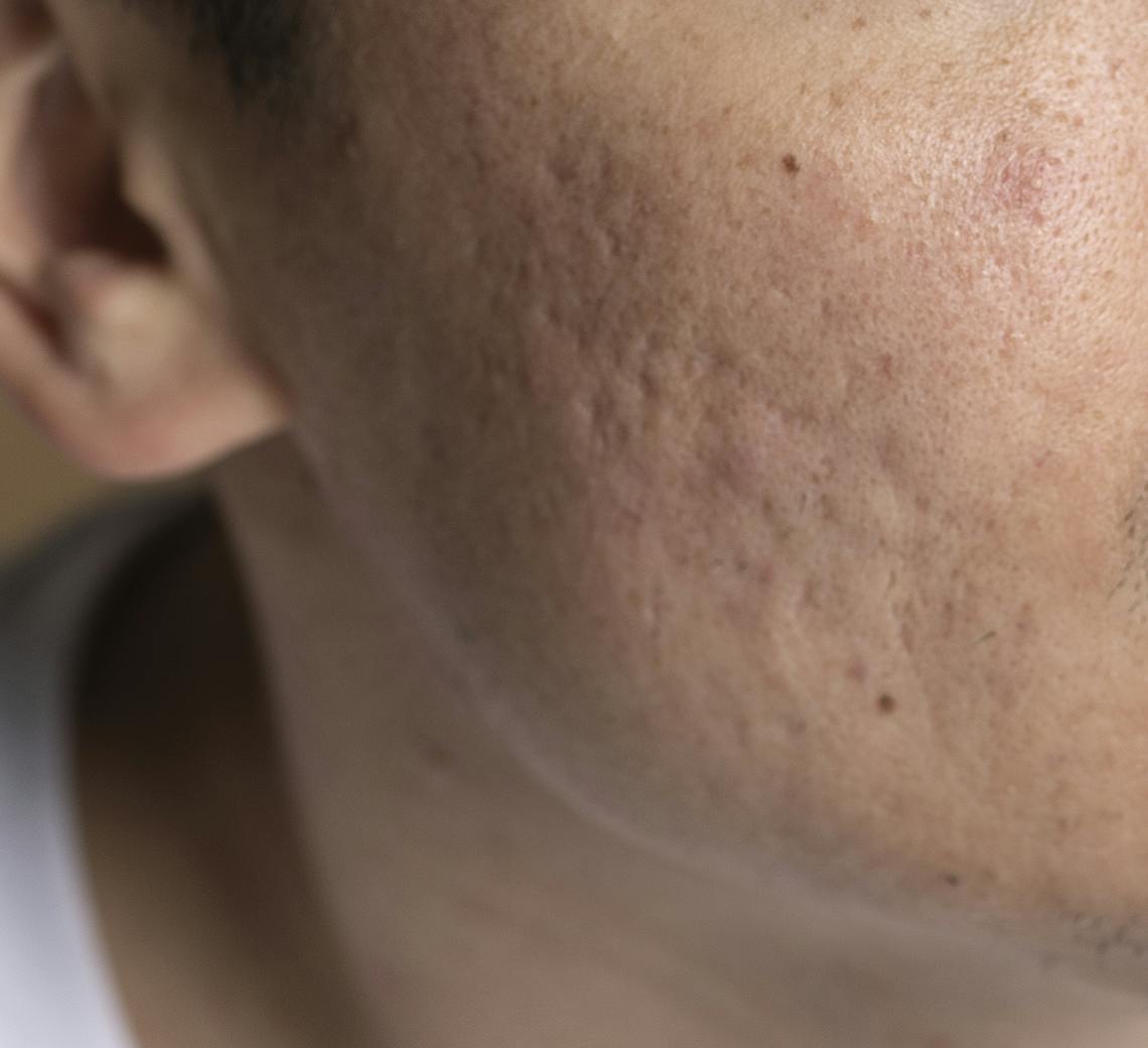 laser cicatrice d'acné Lyon | Maison Yokō