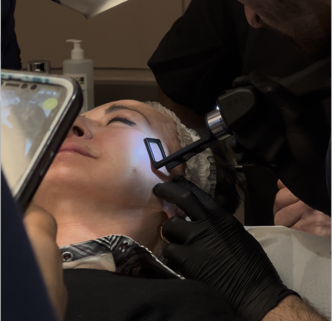 abrasion des cicatrices d'acné sur le visage par laser co2