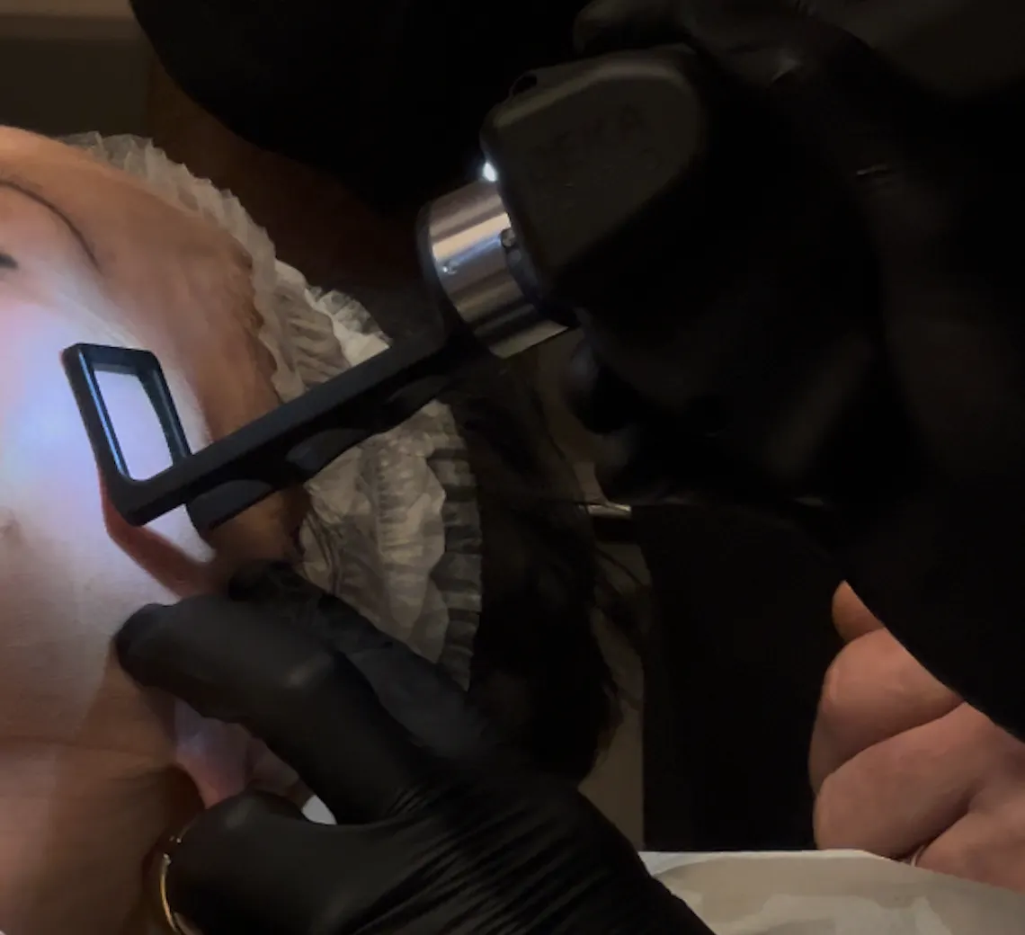 Laser CO₂ fractionné sur le visage : un principe proche du laser CO₂ vaginal, des réglages différents