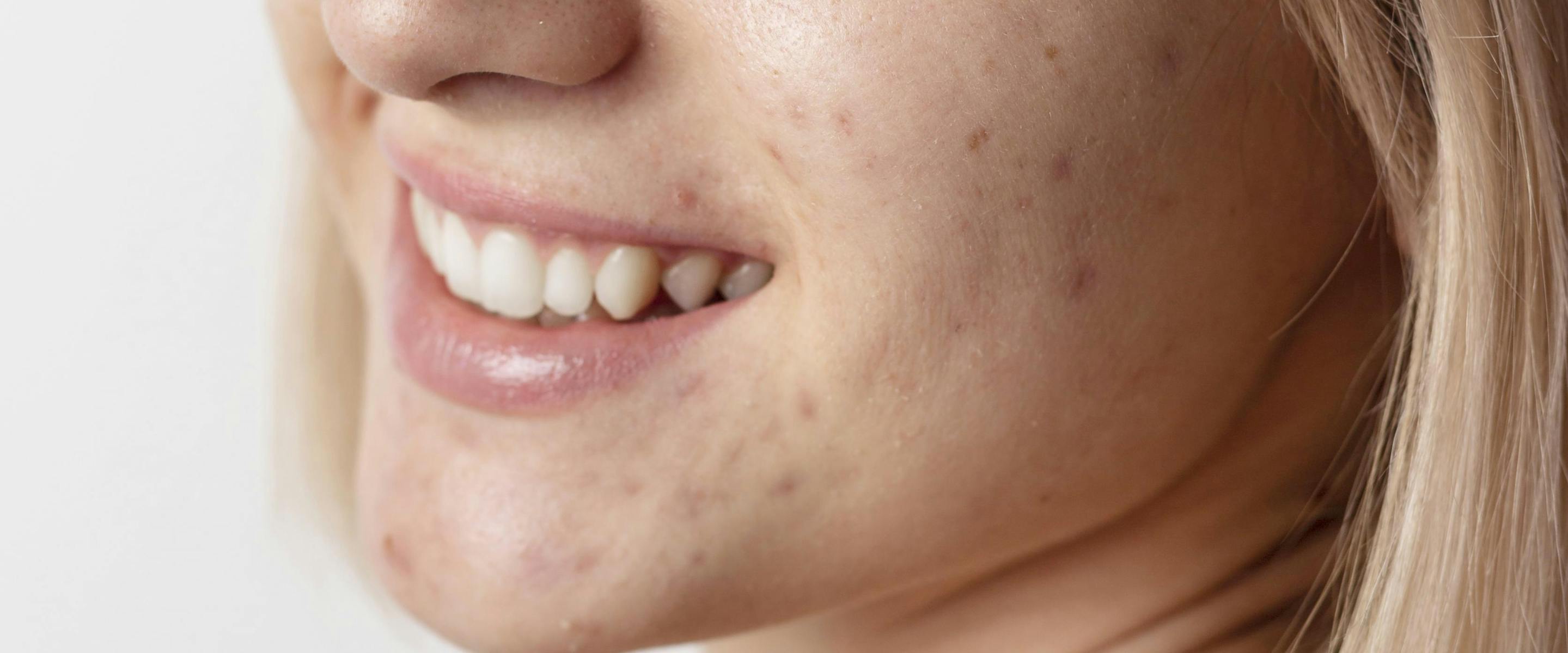 laser co2 cicatrices d'acné | Maison Yokō