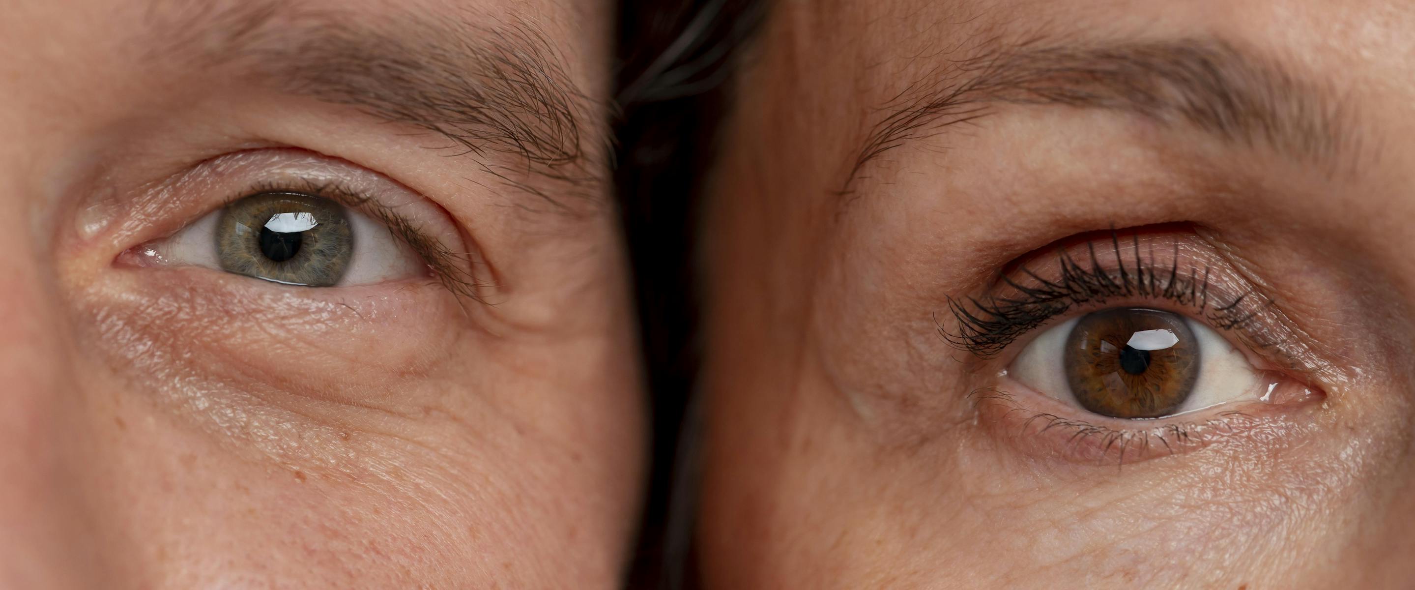 laser co2 pour les rides sous les yeux | Maison Yokō