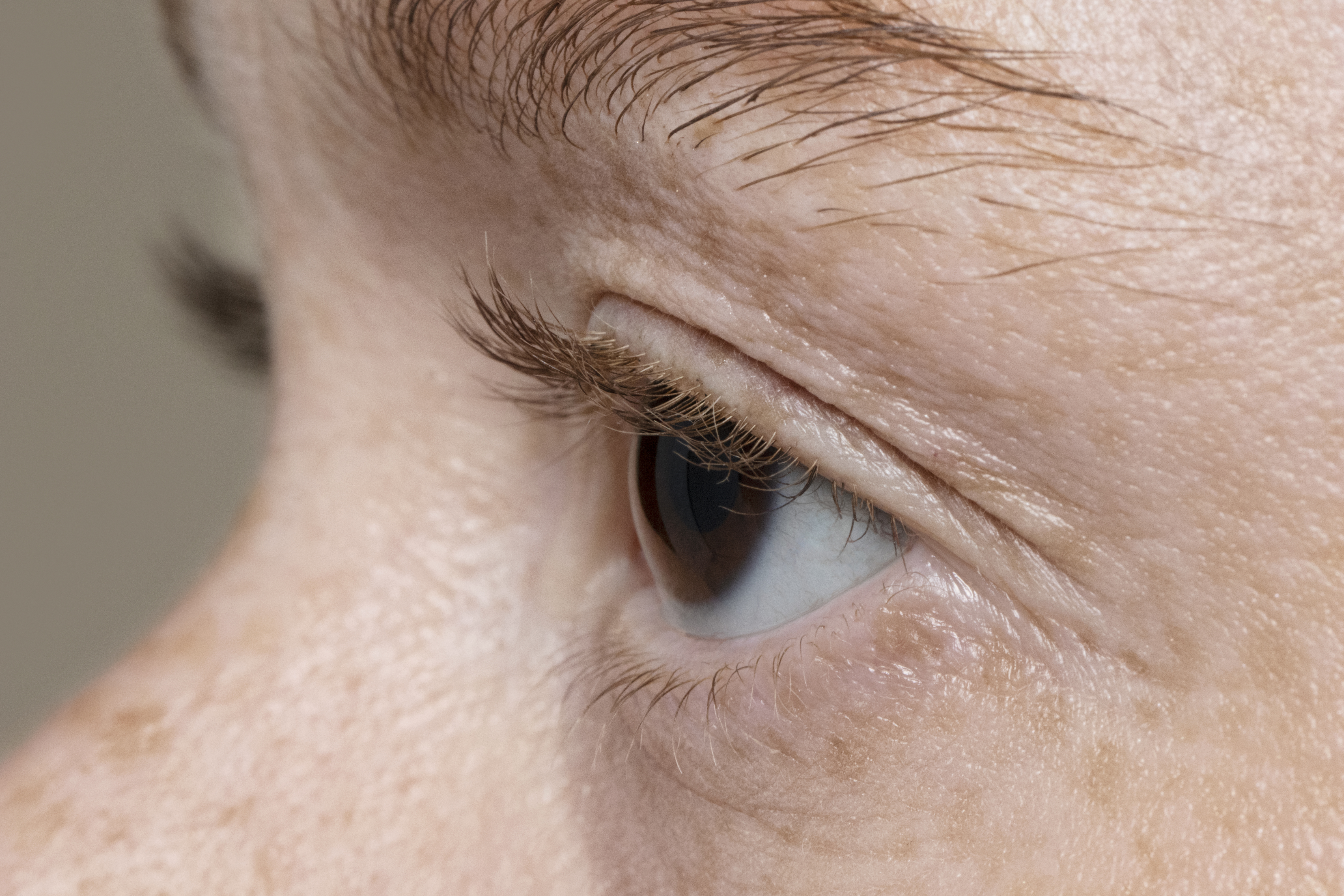 résultats laser co2 autour des yeux