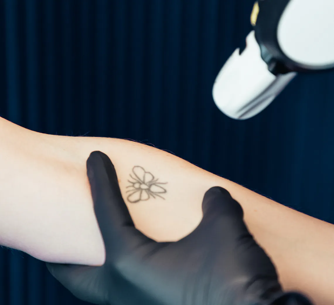 Comment reconnaître une brûlure laser ? | Maison Yokō