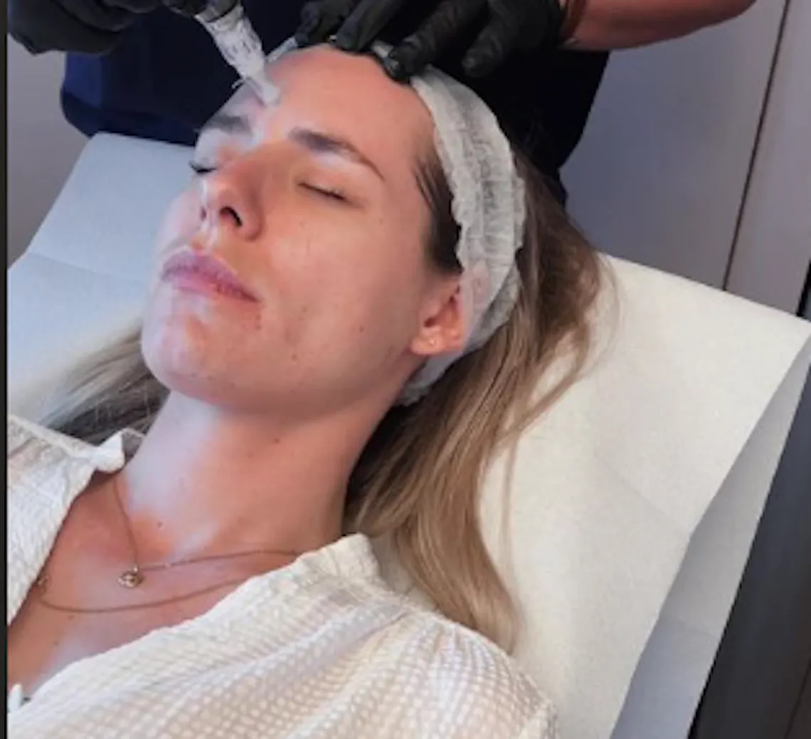 Soin skincare Maison Yoko : microneedling