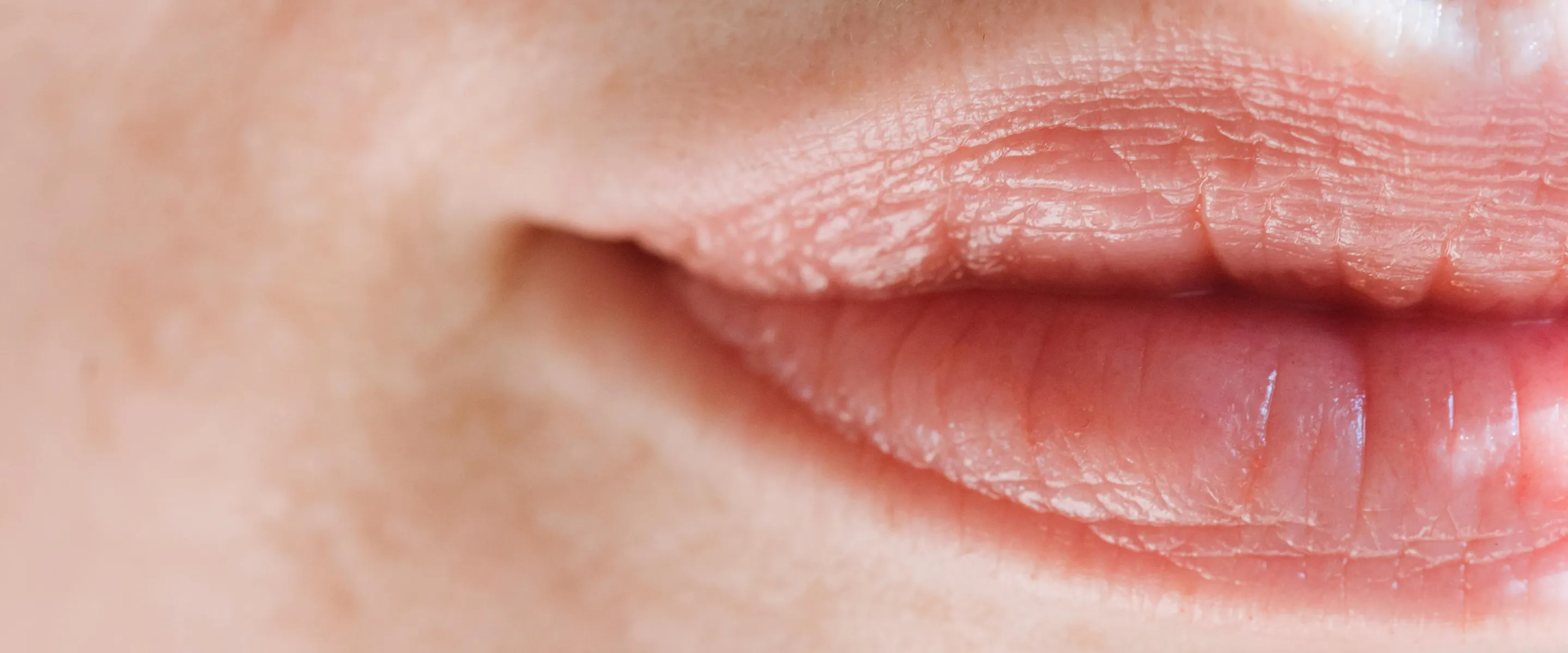 Lèvres asymétriques : correction par acide hyaluronique ?