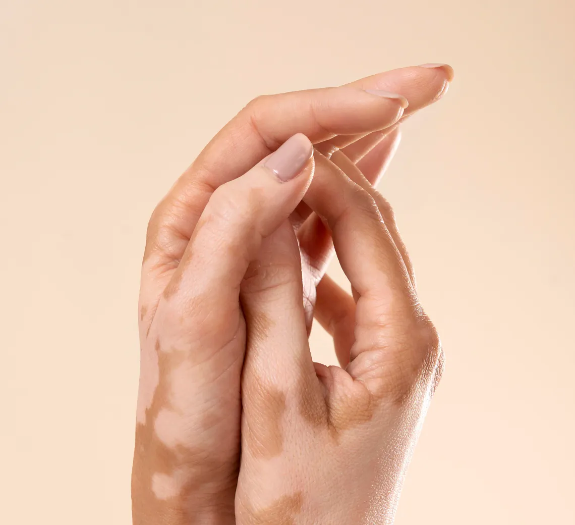 tâches de vieillesse sur les mains | laser tâches brunes