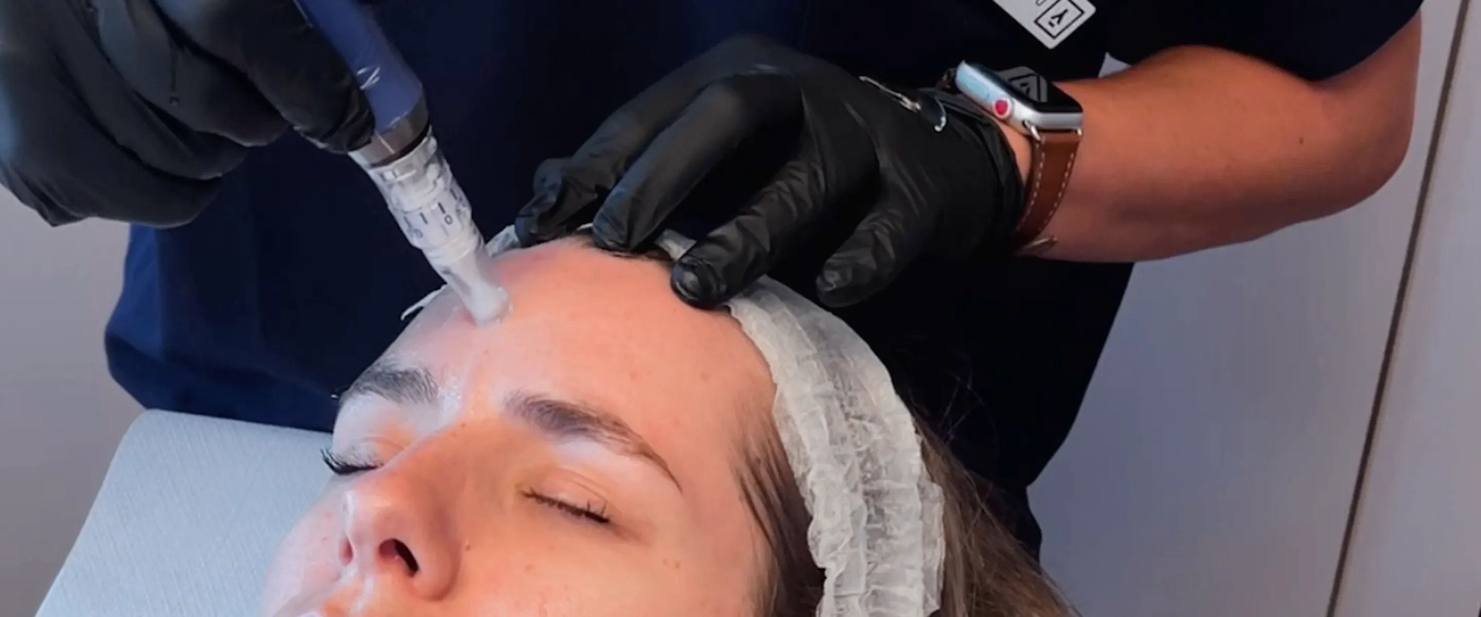 Praticien réalisant un Microneedling sur une patiente.