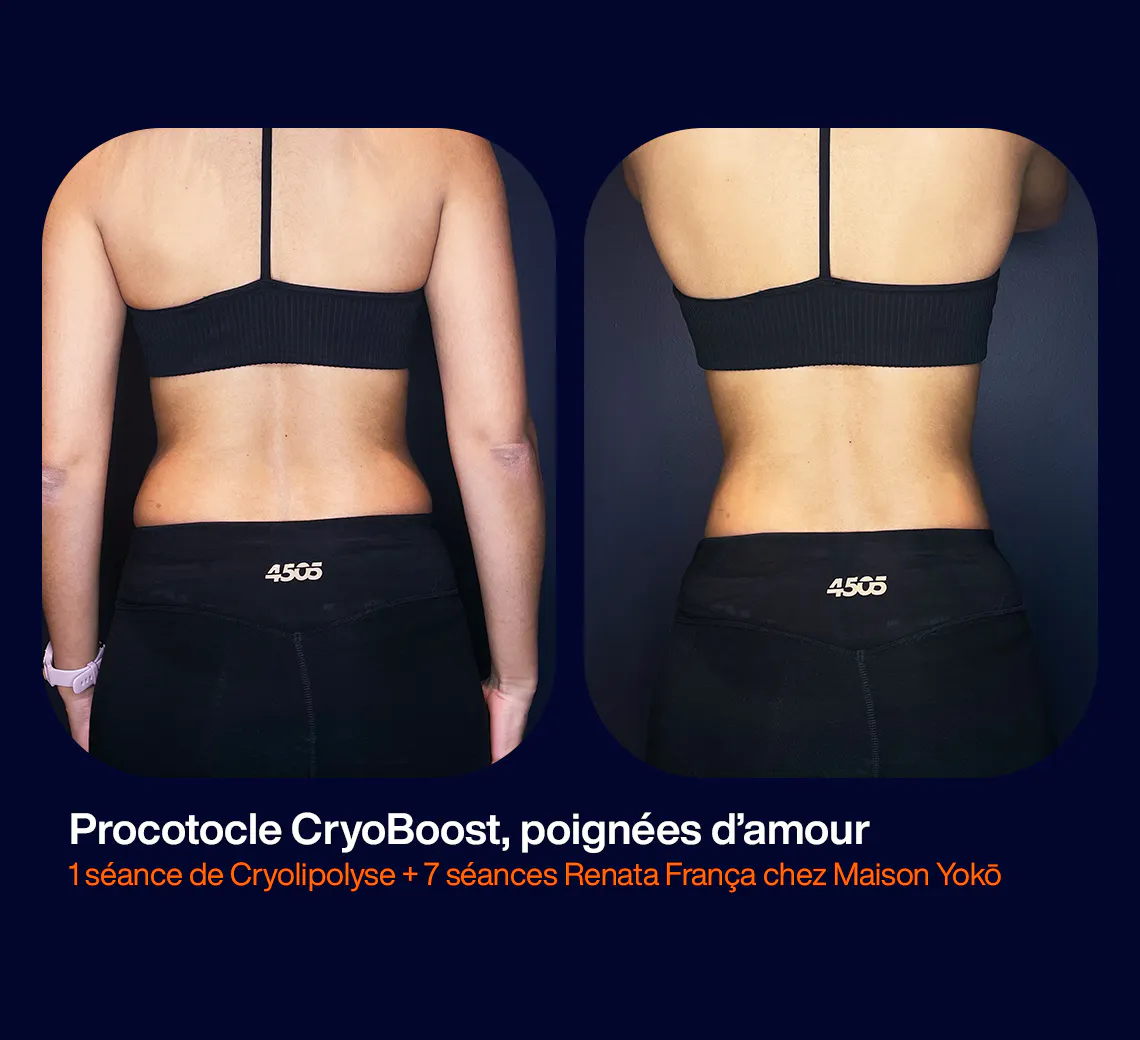 Résultats de l'alliance du traitement cryolipolyse sur les poignées d'amour et d'une cure de massages drainants Renata França, réalisée dans le centre de médecine esthétique et laser Maison Yoko, situé à Lyon Place Bellecour