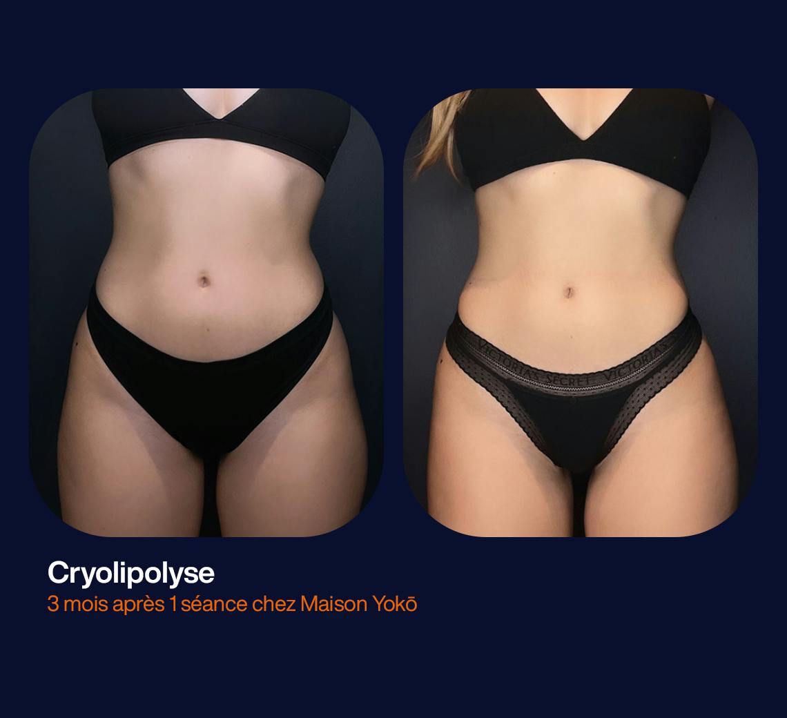 résultat cryolipolyse du ventre chez Maison Yokō