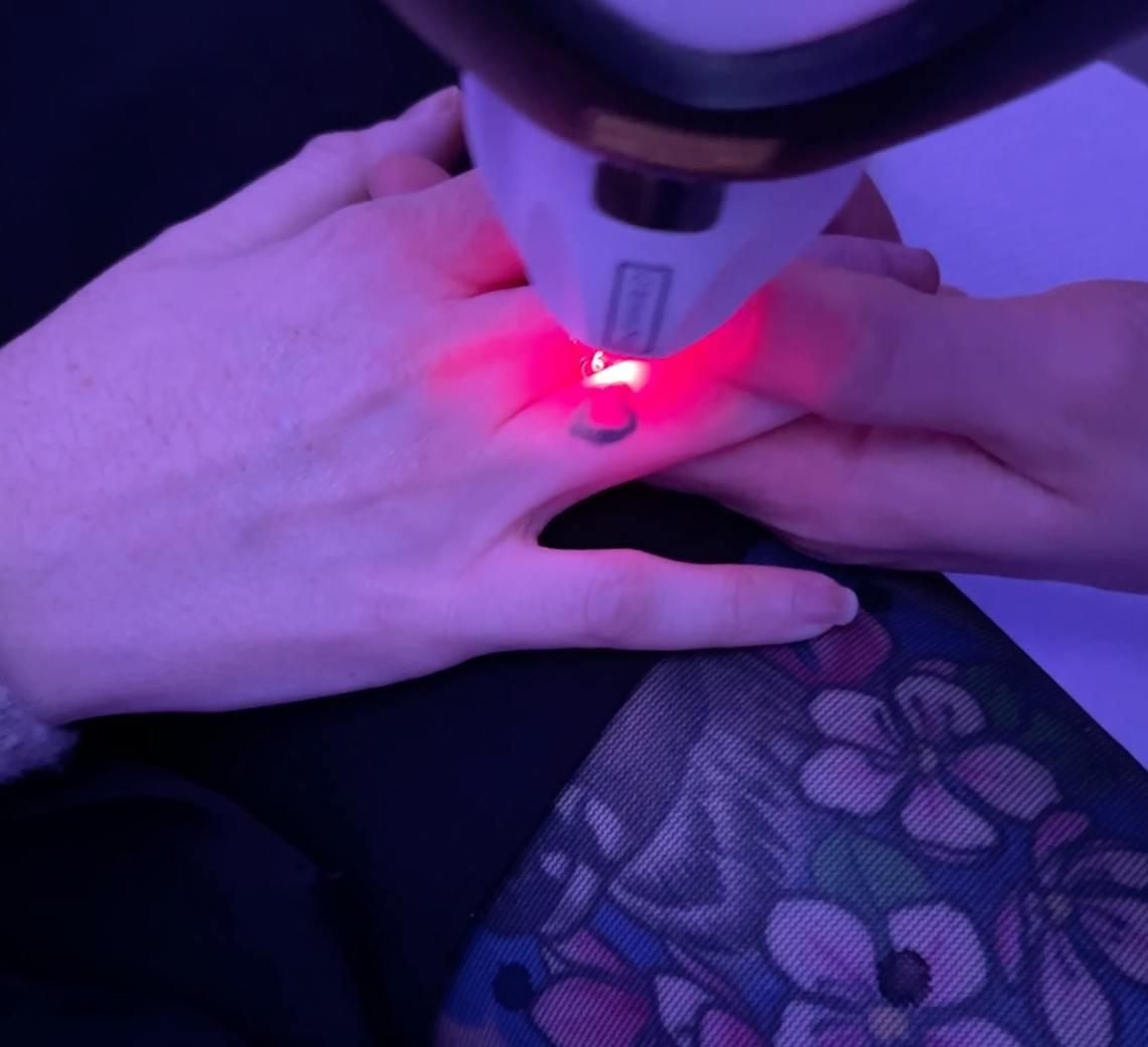 se faire enlever un tatouage au laser