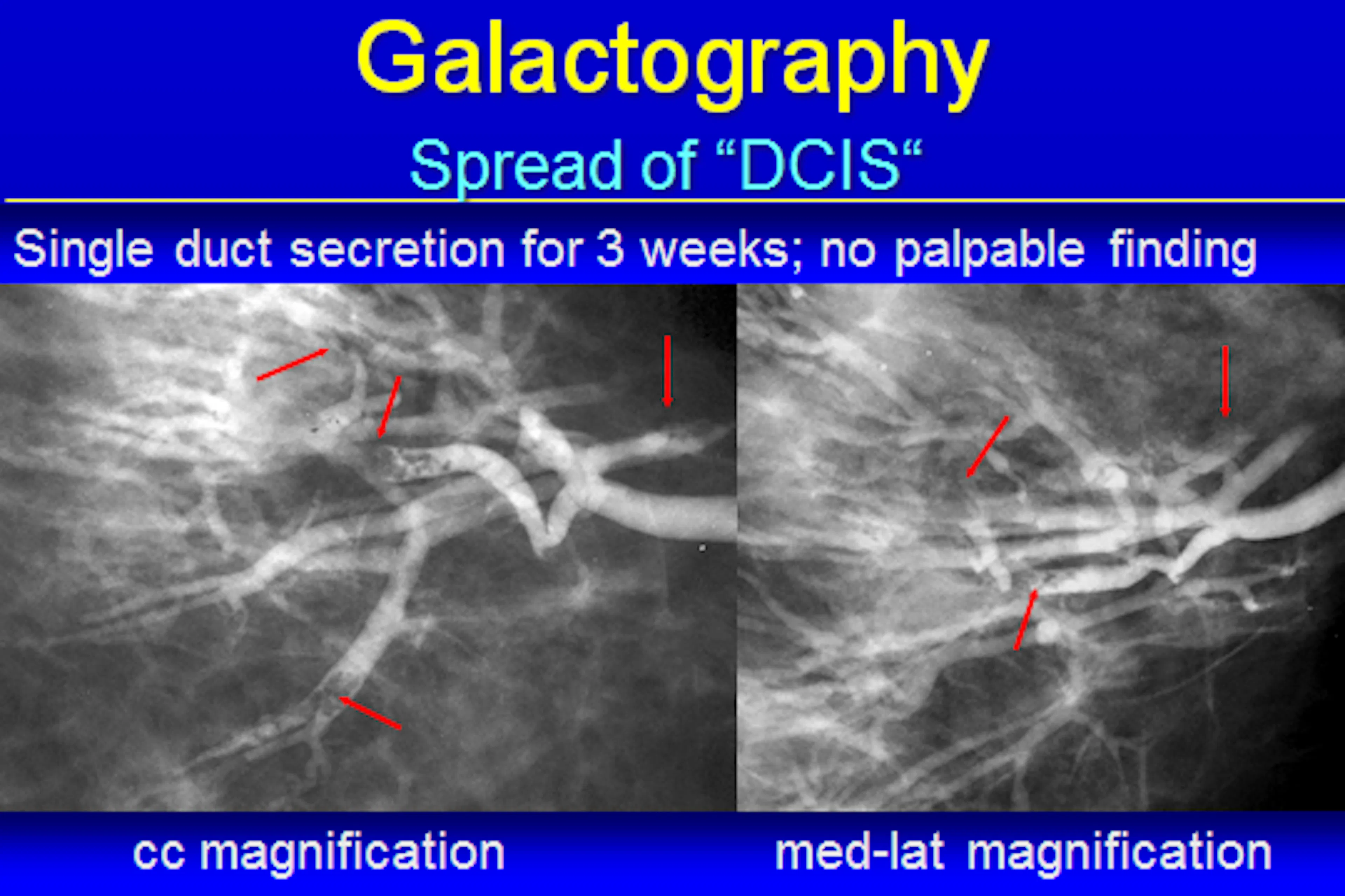 LSDR konferencija 2011-27 Skaidrės iš A.Mundinger ( Vokietija)  pranešimo The new insights in the imgining of DCIS. Update of preoperative Staging of Breast cancer and lymph nodes