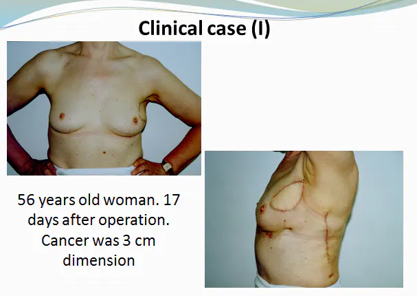 2011-05-27 Skaidrės iš S.Bružo (Lietuva), pranešimo Breast conserving Surgery and Reconstructions