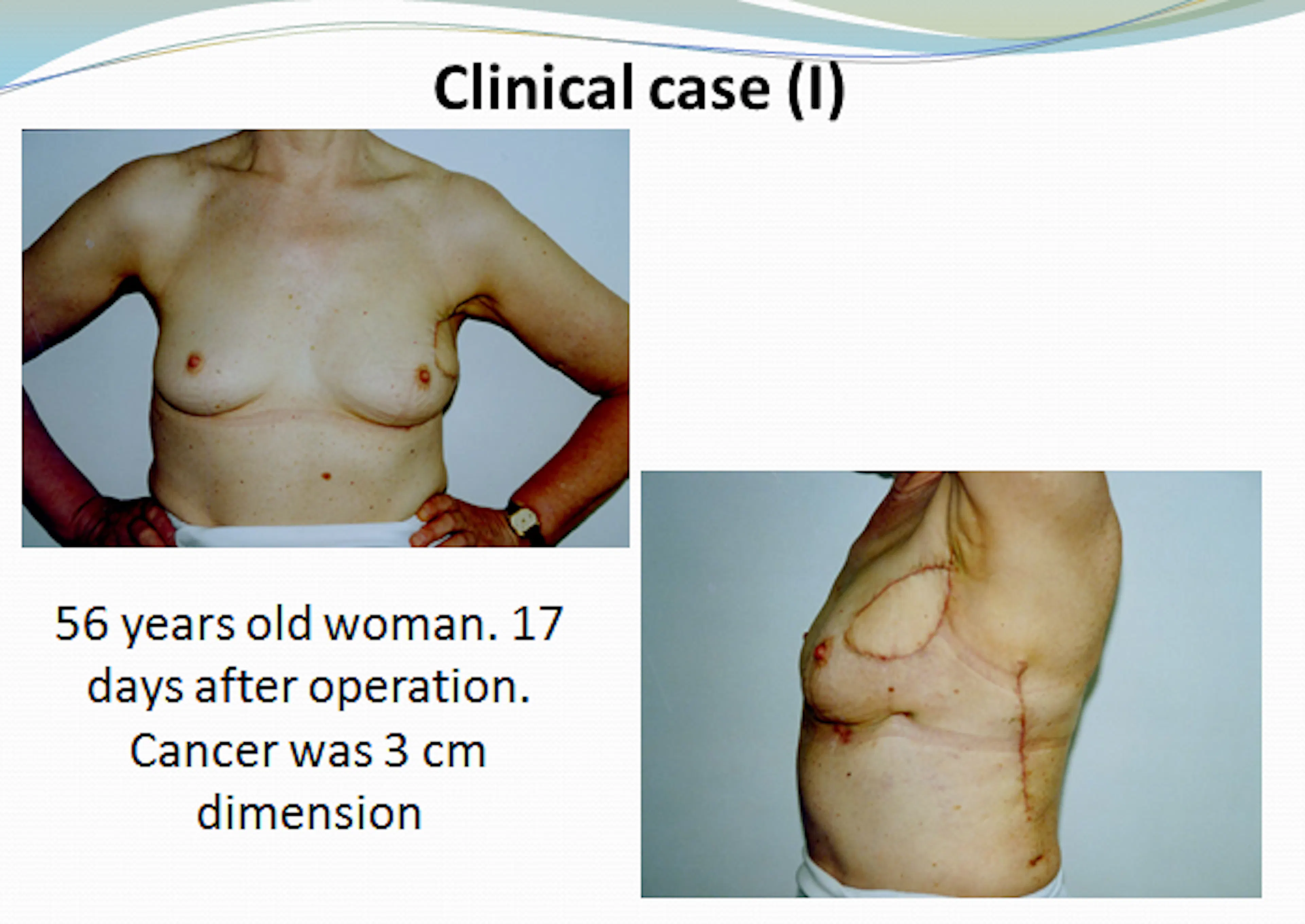 2011-05-27 Skaidrės iš S.Bružo (Lietuva), pranešimo  Breast conserving Surgery and Reconstructions