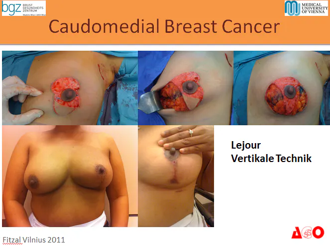 Skaidrė 2011-05-27 Skaidrės iš F.Fitzal (Austrija) pranešimo "Oncoplastic Breast Surgery"