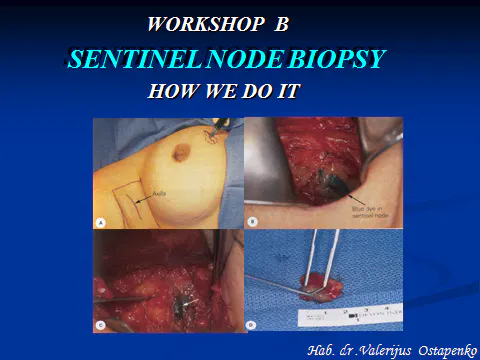 2011-05-28 Workshop B Skaidrės iš V.Ostapenko (VUOI) Lietuva pranešimo "Sentinel node Biopsy"