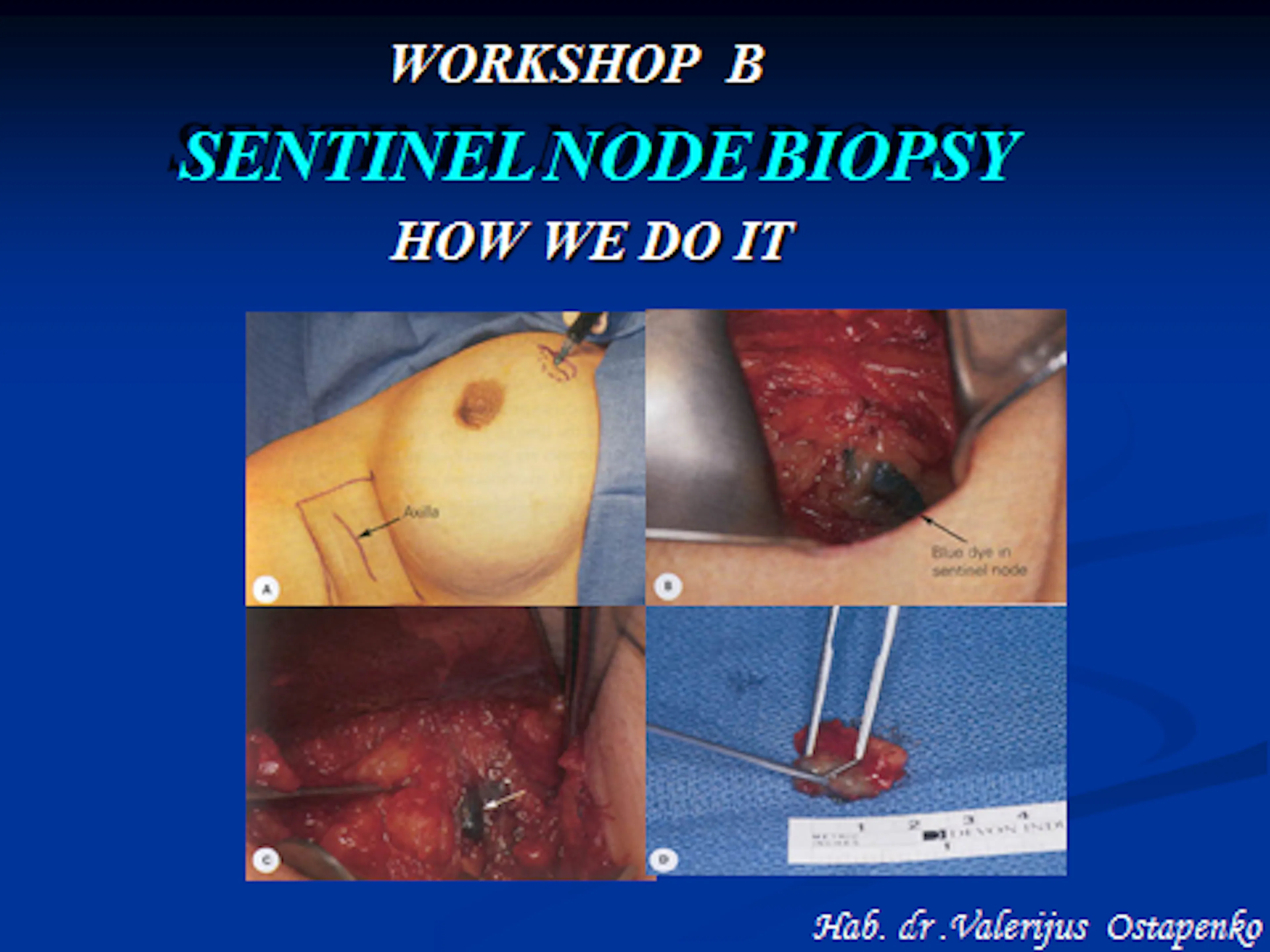 2011-05-28 Workshop B Skaidrės iš   V.Ostapenko (VUOI)  Lietuva pranešimo "Sentinel node Biopsy"