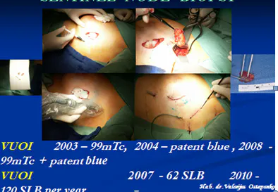 2011-05-28 Workshop B Skaidrės iš V.Ostapenko (VUOI) Lietuva pranešimo "Sentinel node Biopsy"