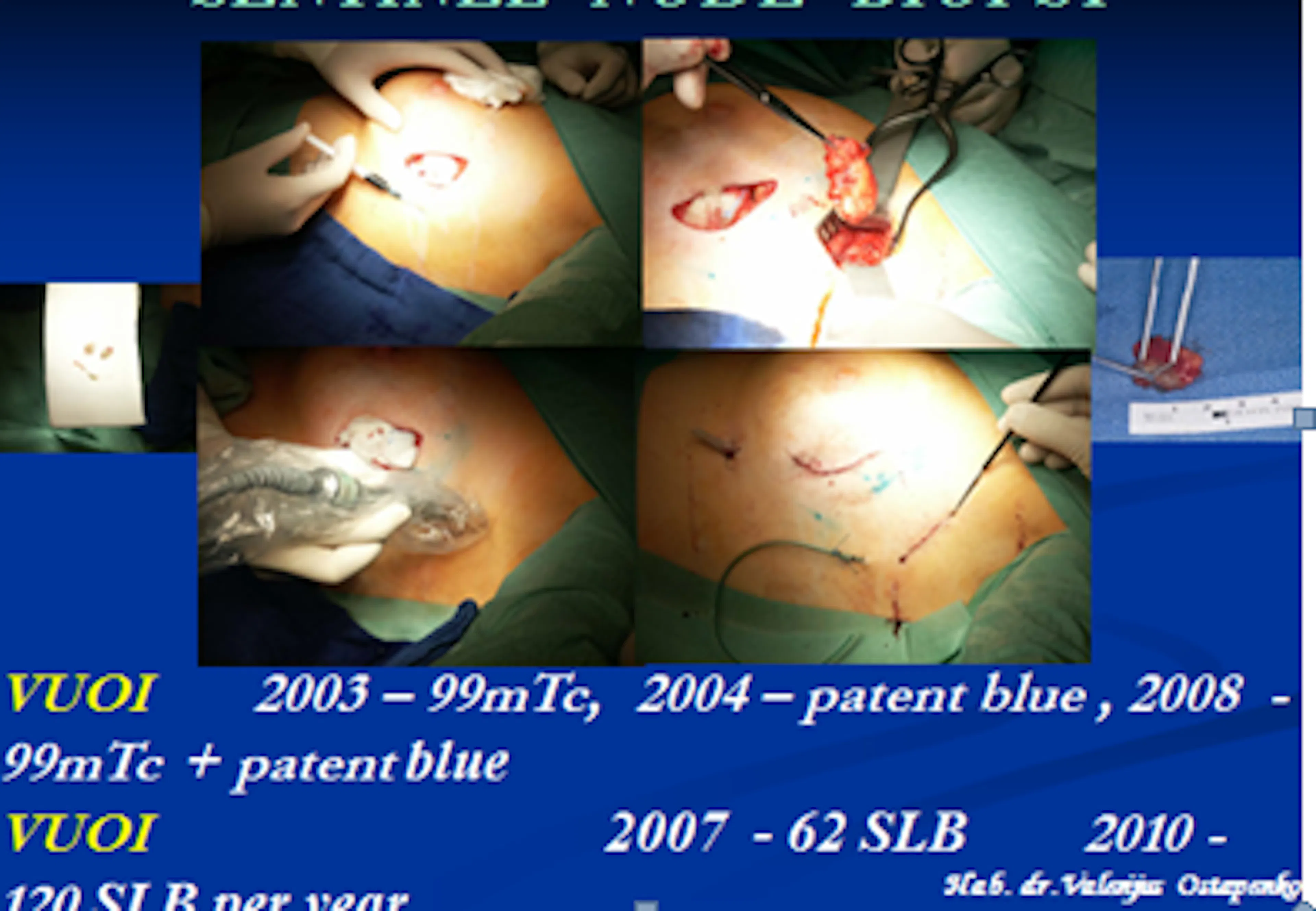 2011-05-28 Workshop B Skaidrės iš   V.Ostapenko (VUOI)  Lietuva pranešimo "Sentinel node Biopsy"