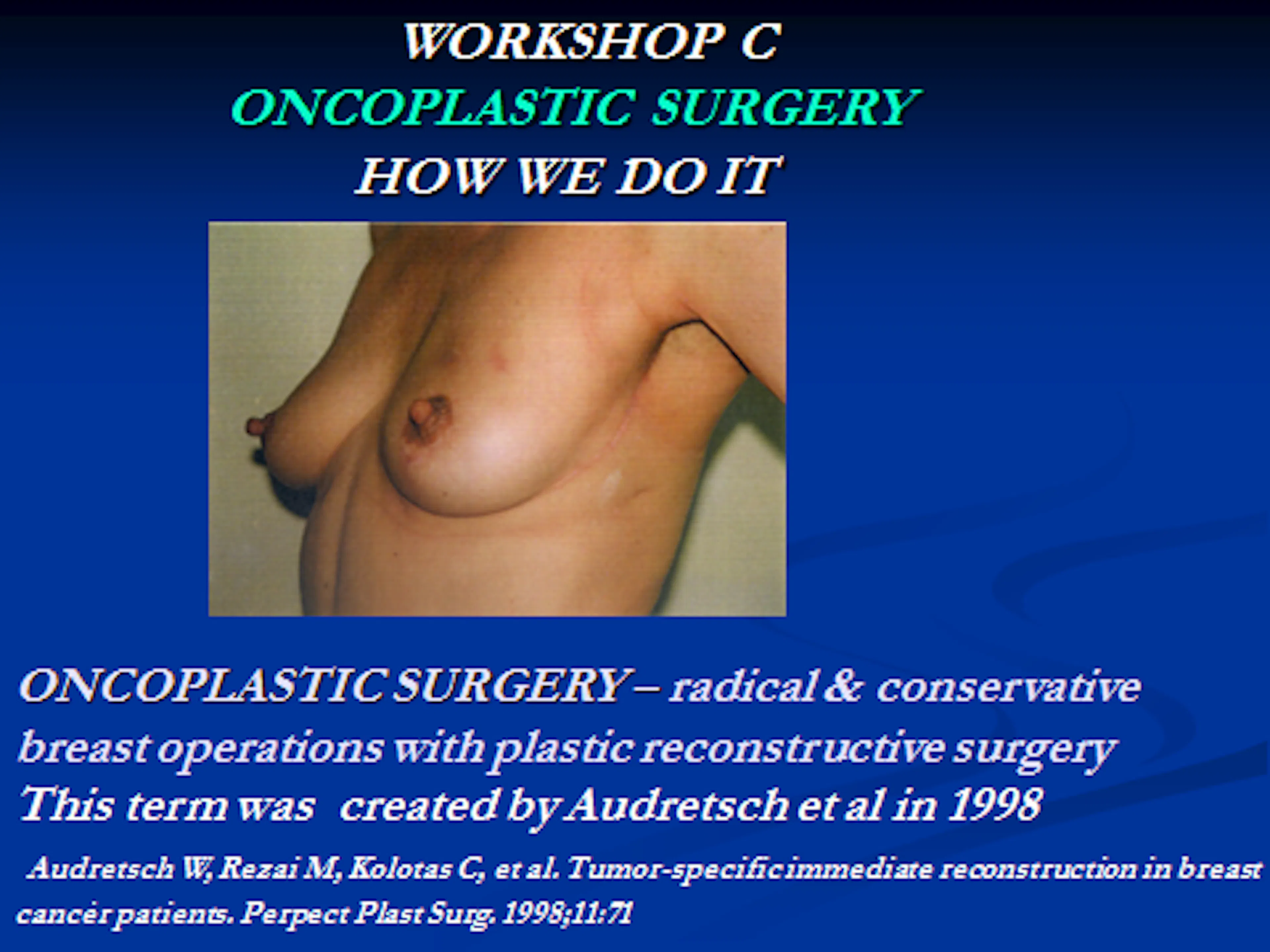 Workshop C. Skaidrės iš V.Ostapenko pranešimo "Oncoplastic Surgery how we do it". VUOI Vilnius, Lithuania