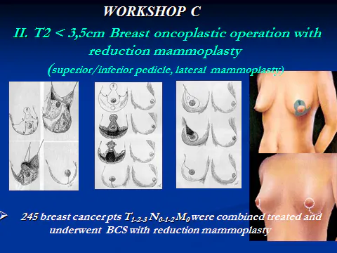 Workshop C. Skaidrės iš V.Ostapenko pranešimo "Oncoplastic Surgery how we do it". VUOI Vilnius, Lithuania