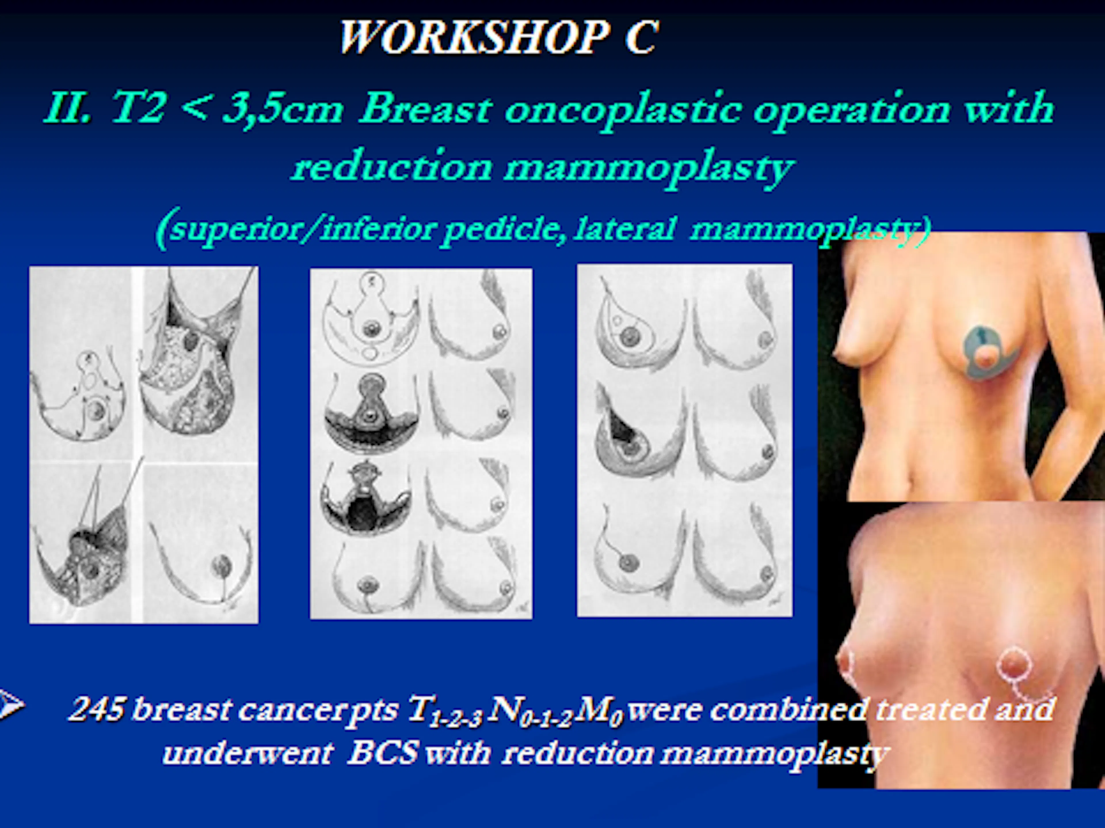 Workshop C. Skaidrės iš V.Ostapenko pranešimo "Oncoplastic Surgery how we do it". VUOI Vilnius, Lithuania