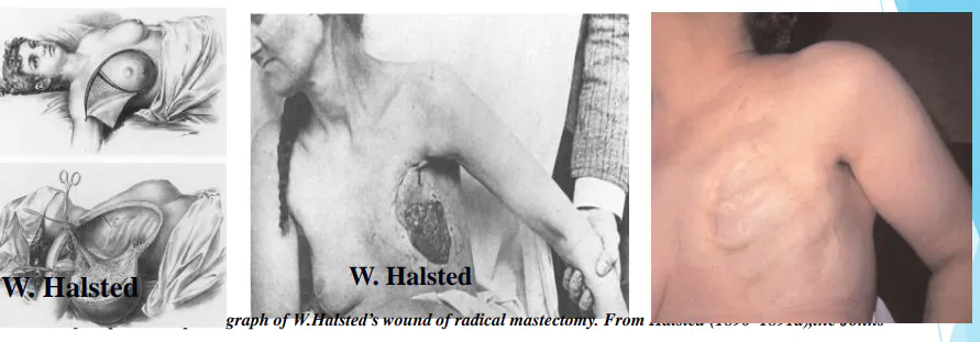 Skaidrė iš V. Ostapenko pranešimo apie krūties vėžio chirurginio gydymo evoliuciją