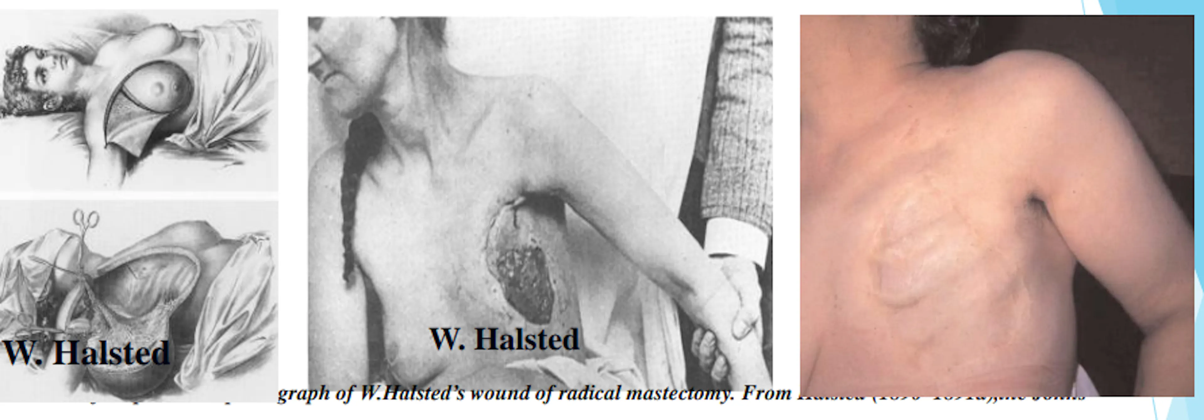 Skaidrė iš V. Ostapenko pranešimo apie krūties vėžio chirurginio gydymo evoliuciją