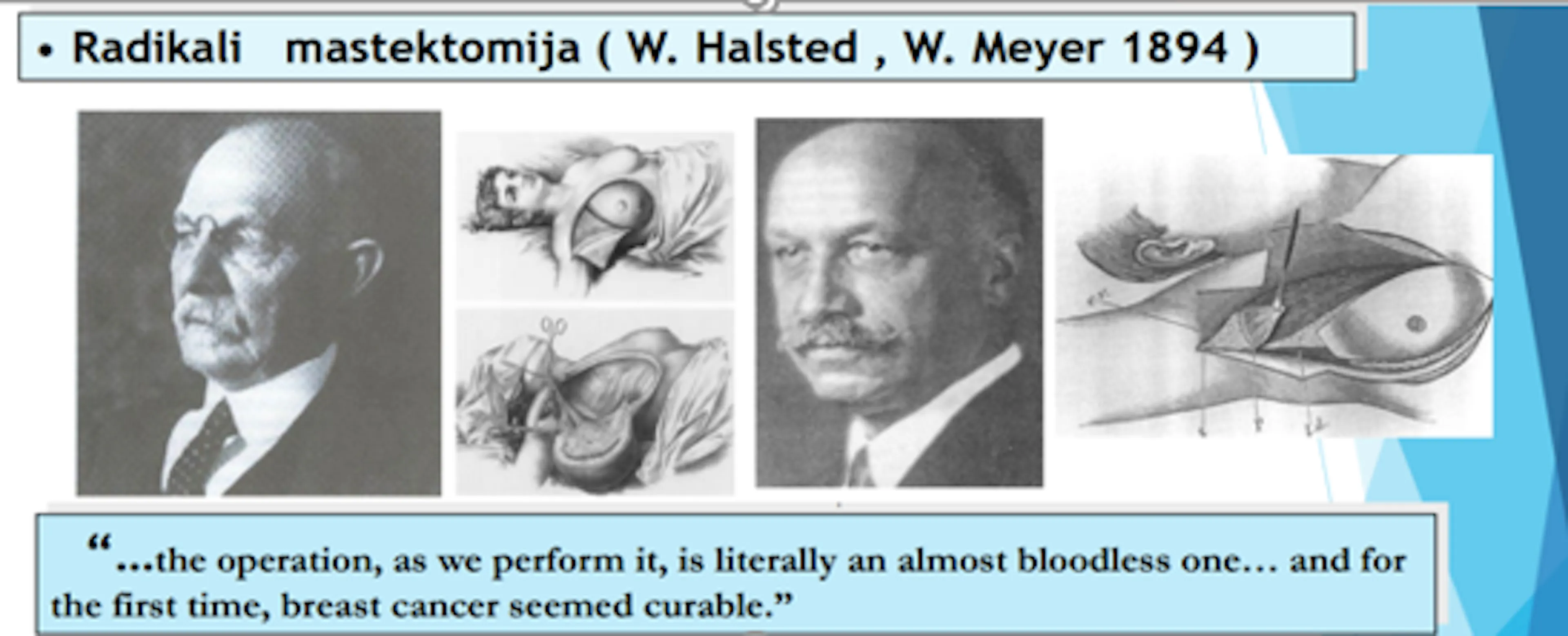 Skaidrė  iš V. Ostapeko  pranešimo apie krūties vėžio chirurginio gydymo evoliuciją