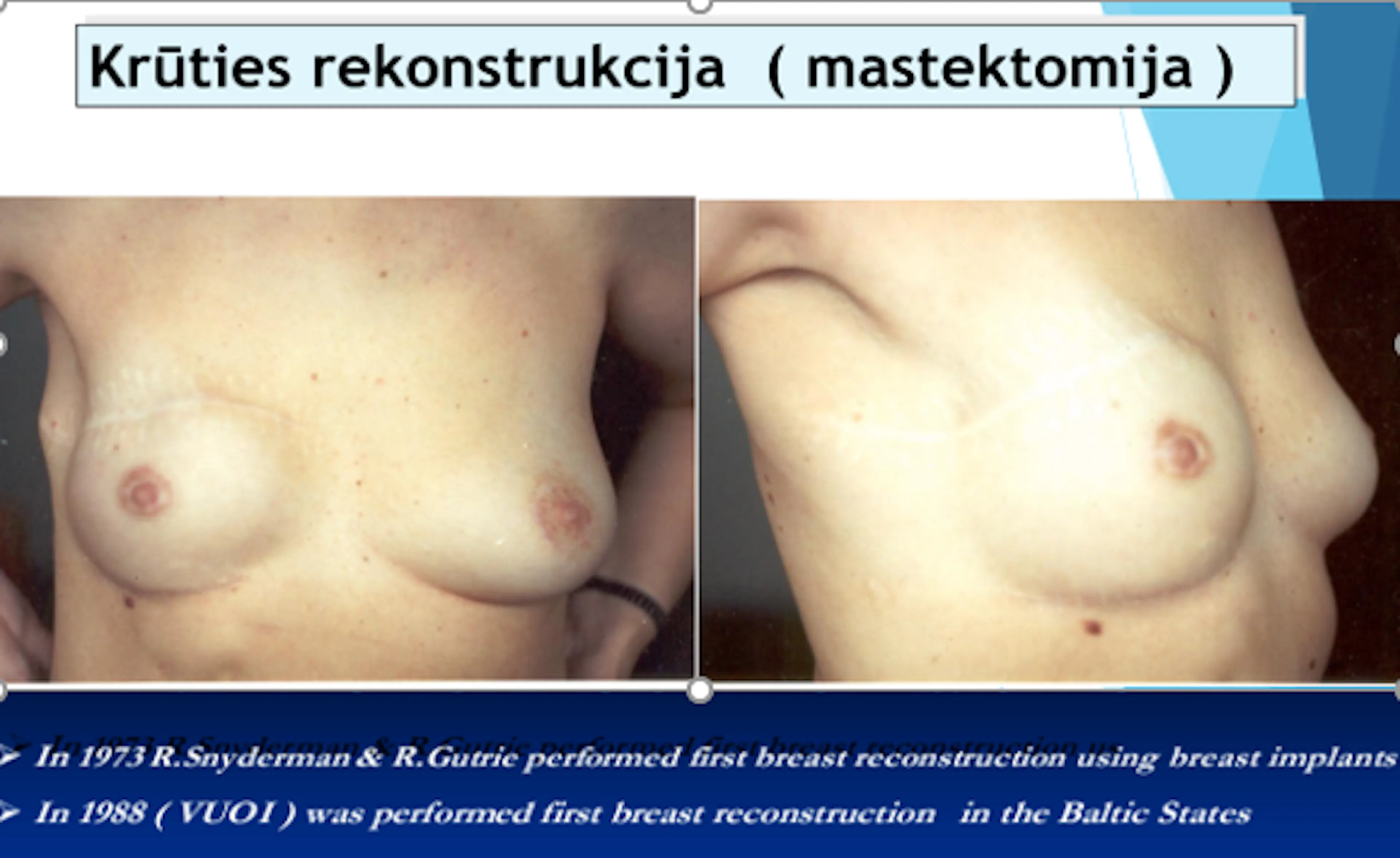 Skaidrė iš V. Ostapenko pranešimo apie pirmąją krūties vėžio rekonstrukcijas