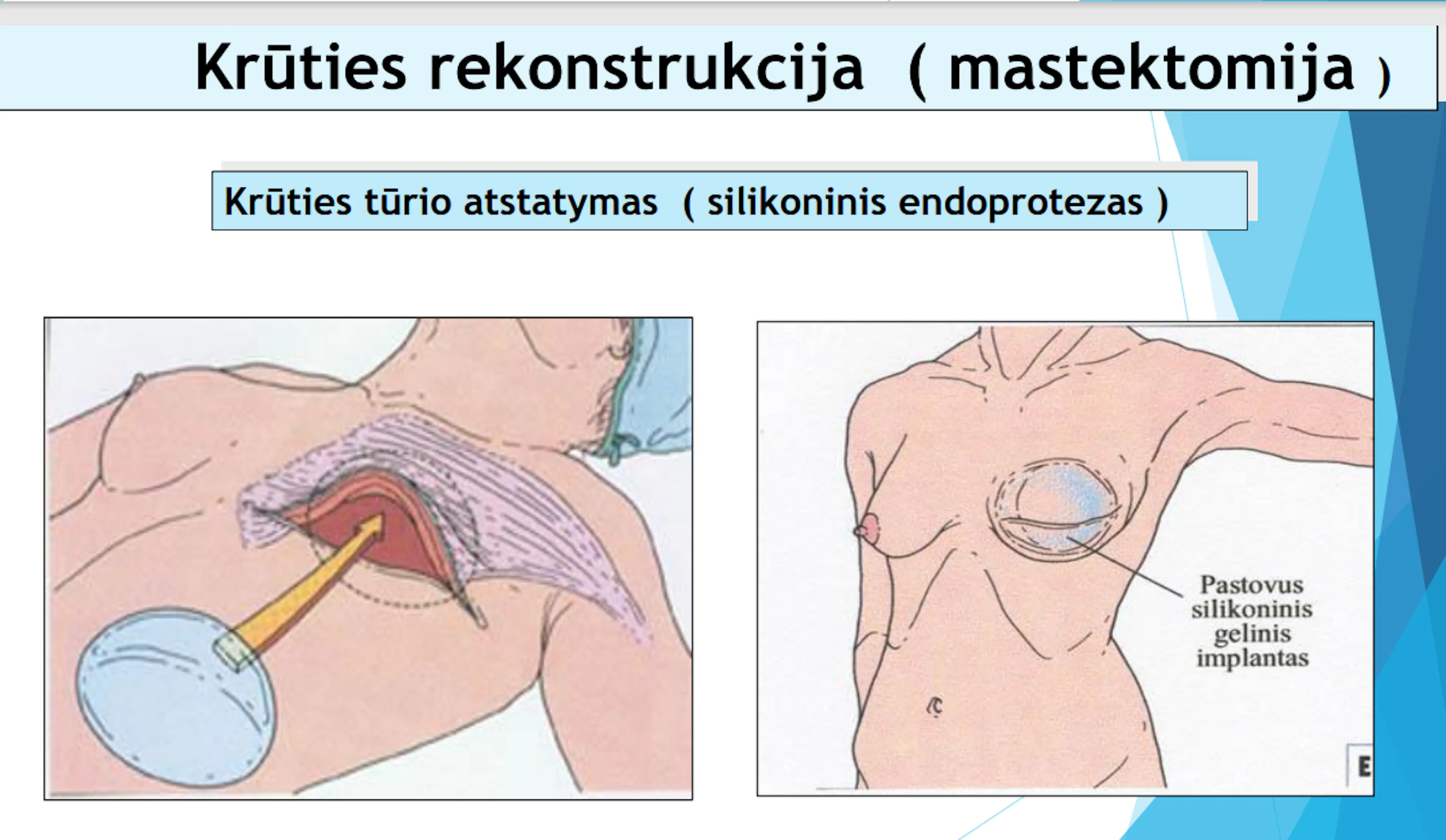Skaidrė iš V. Ostapenko pranešimo apie krūties vėžio rekonstrukcijas