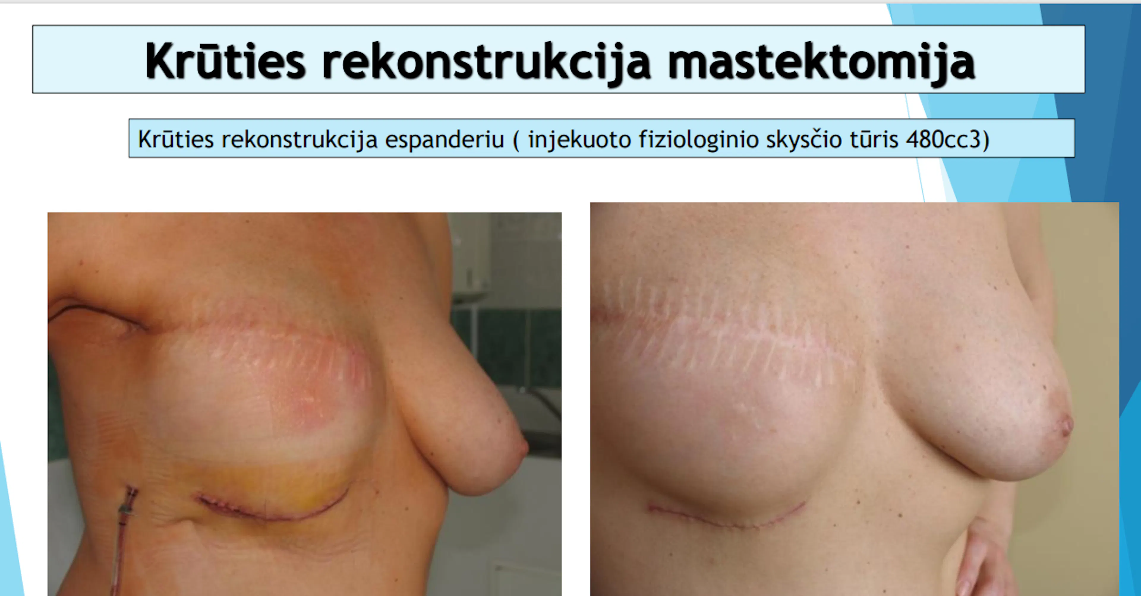 Skaidrė iš V. Ostapenko pranešimo apie krūties vėžio rekonstrukcijas espanderiu