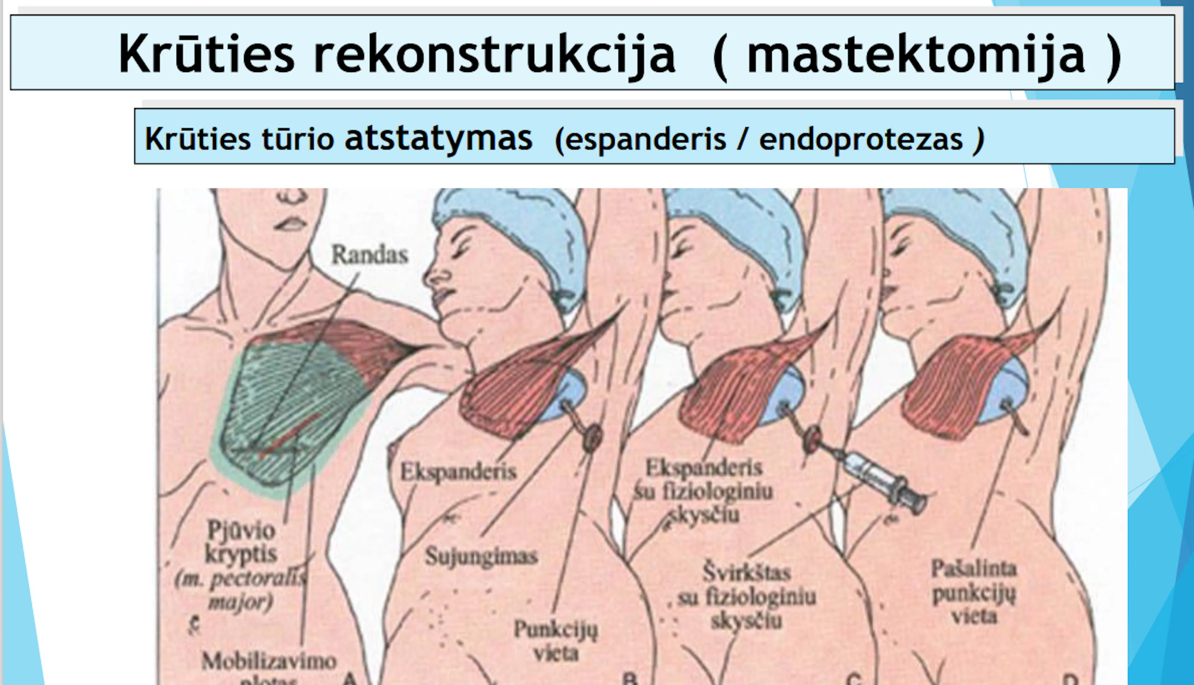 Skaidrė iš V. Ostapenko pranešimo apie krūties vėžio rekonstrukcijas espanderiu