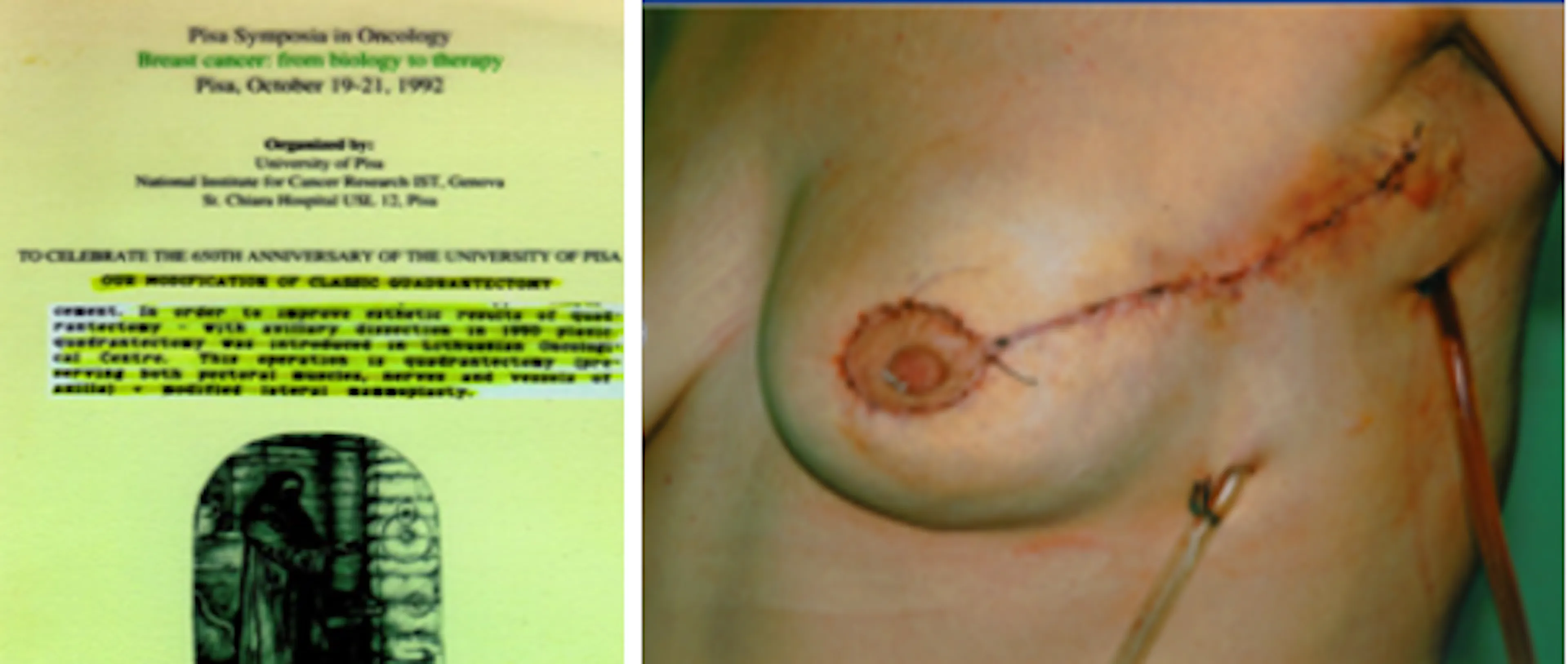 Skaidrė iš V. Ostapenko pranešimo apie plastinę kvadrantektomiją