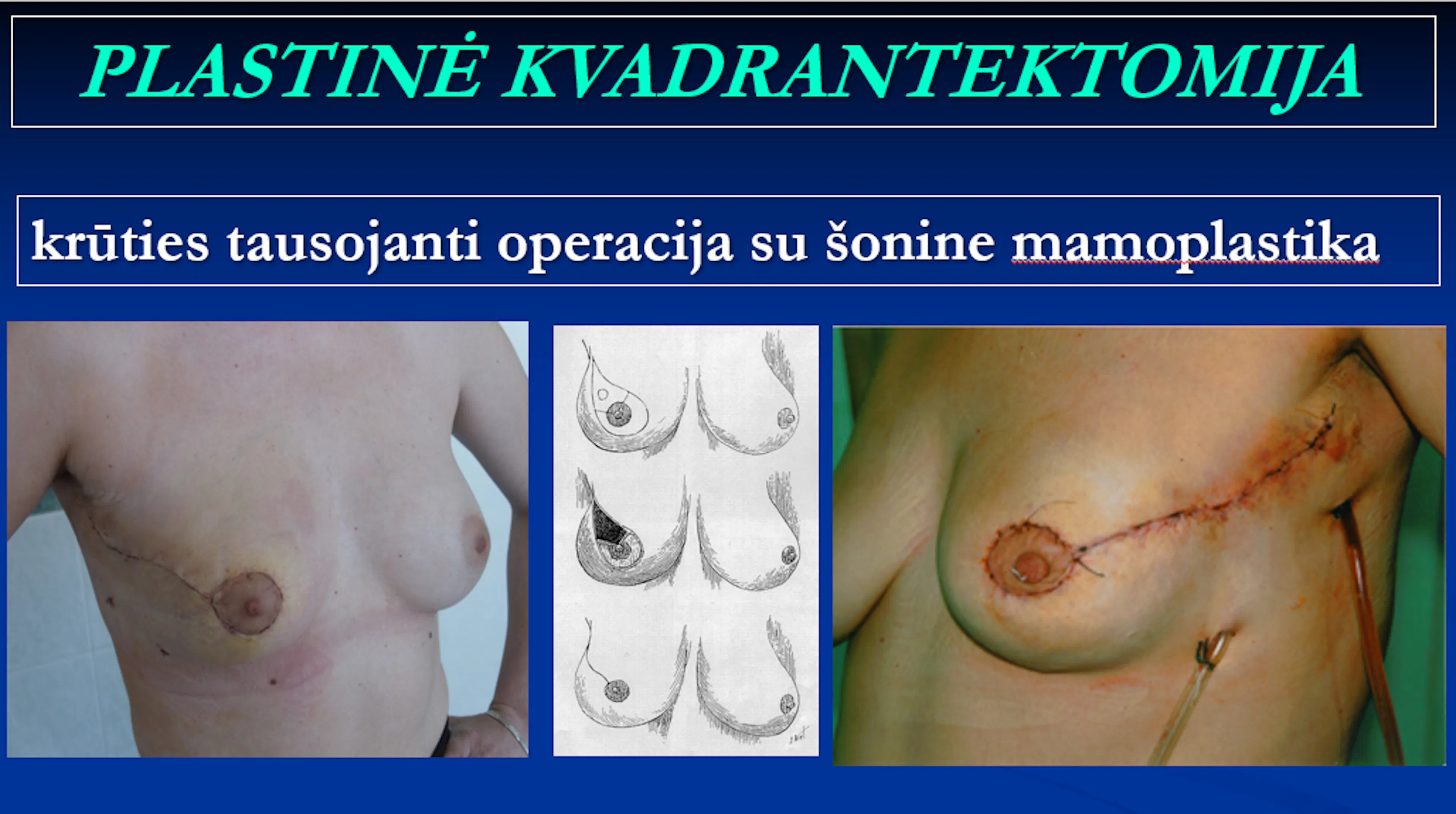Skaidrė iš V. Ostapenko pranešimo apie plastinę kvadrantektomiją